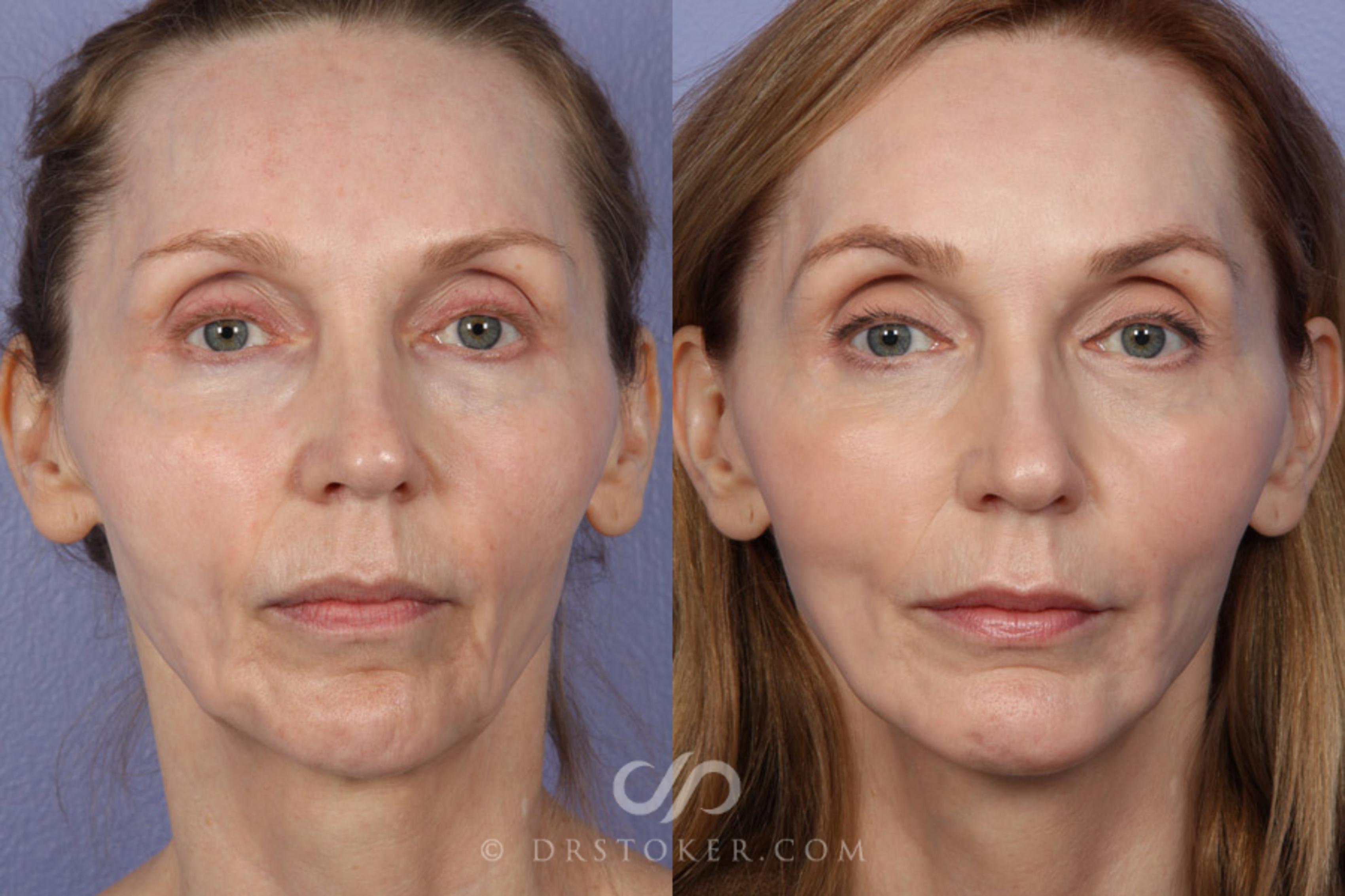 Before & After Cheek/Chin Contouring Case 370 View #1 View in Marina del Rey, CA