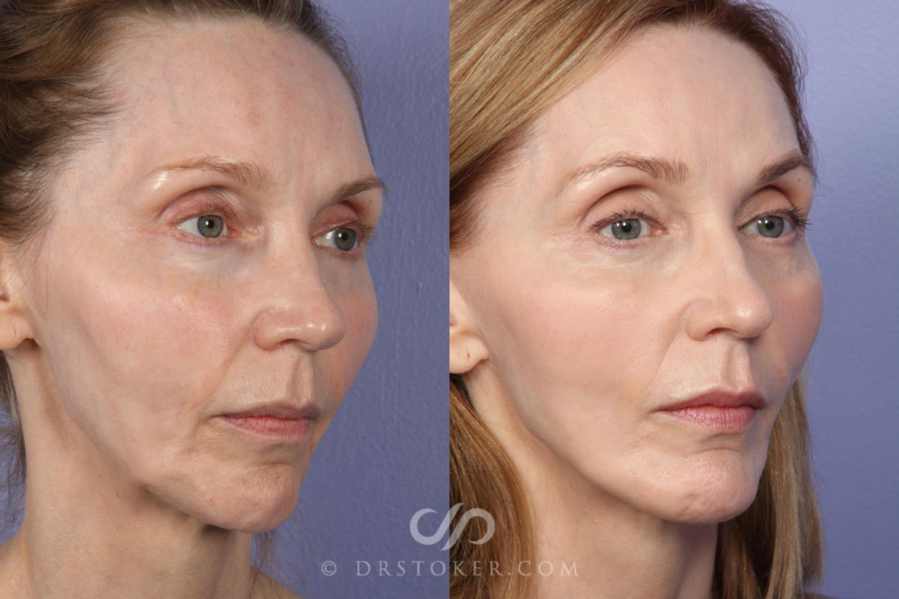 Before & After Buccal Fat Reduction Case 370 View #2 View in Los Angeles, CA