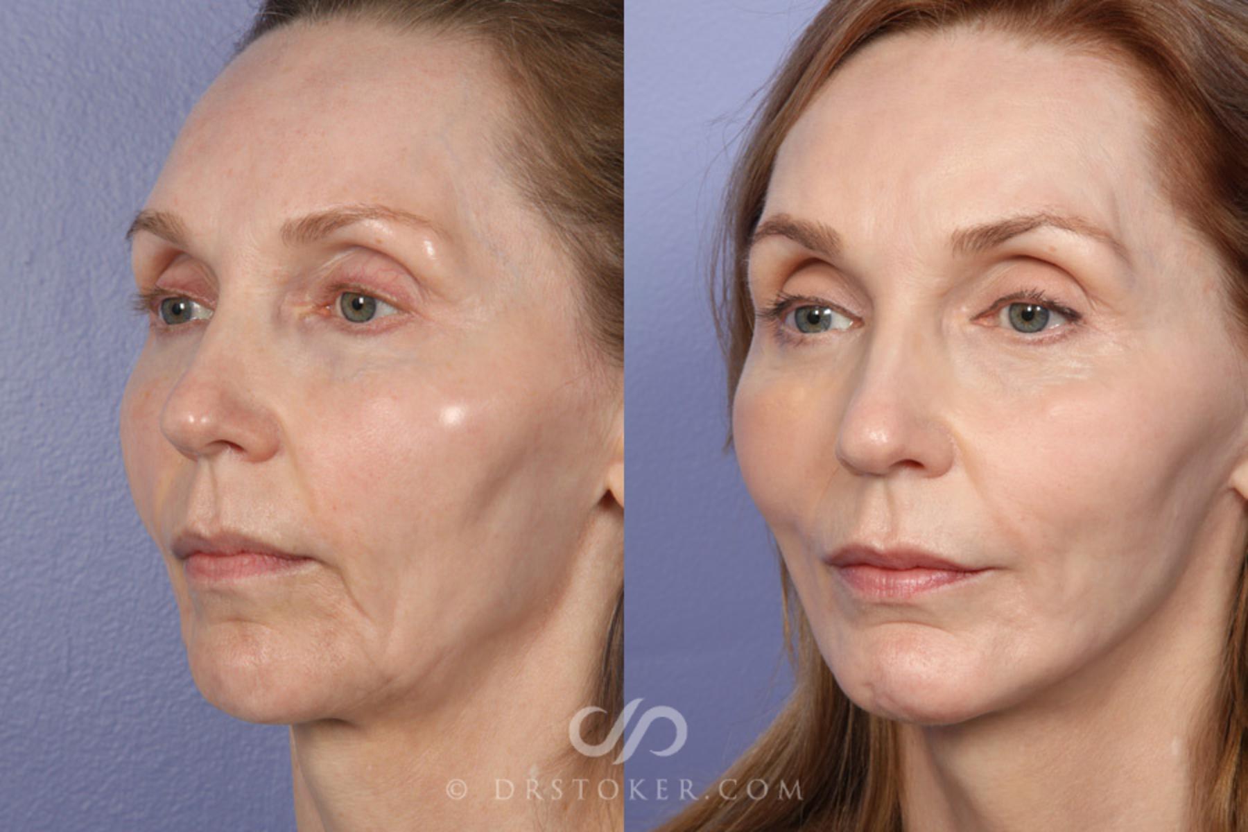 Before & After Cheek/Chin Contouring Case 370 View #3 View in Los Angeles, CA