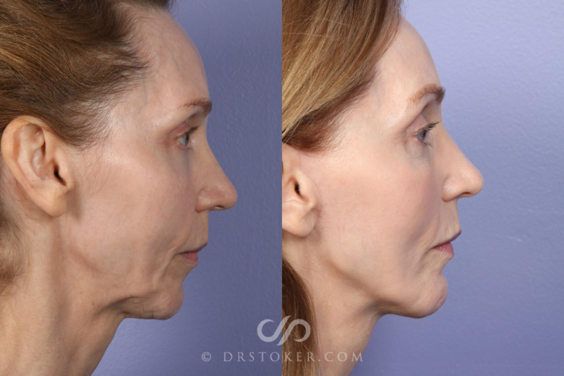 Before & After Cheek/Chin Contouring Case 370 View #4 View in Los Angeles, CA