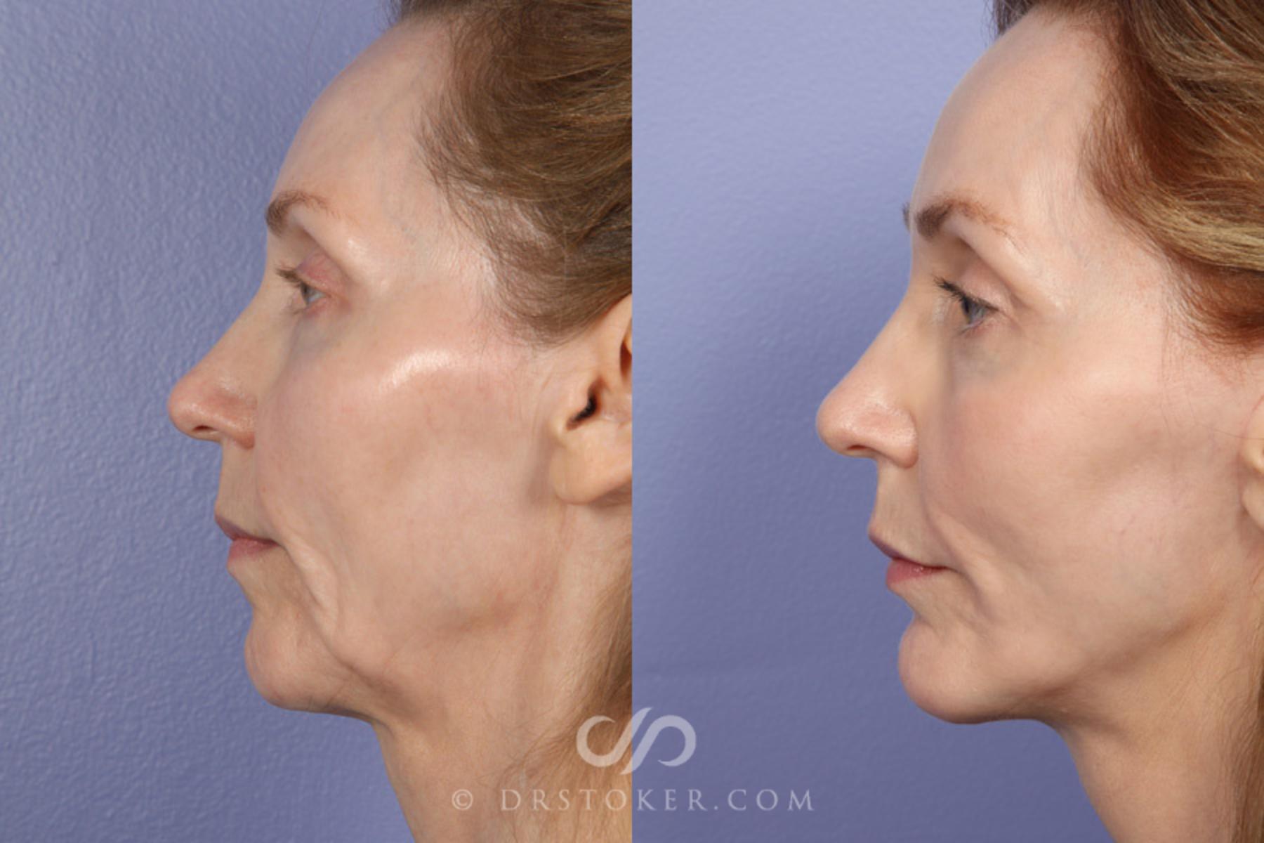 Before & After Facelift - Traceless Facelift Case 370 View #5 View in Los Angeles, CA
