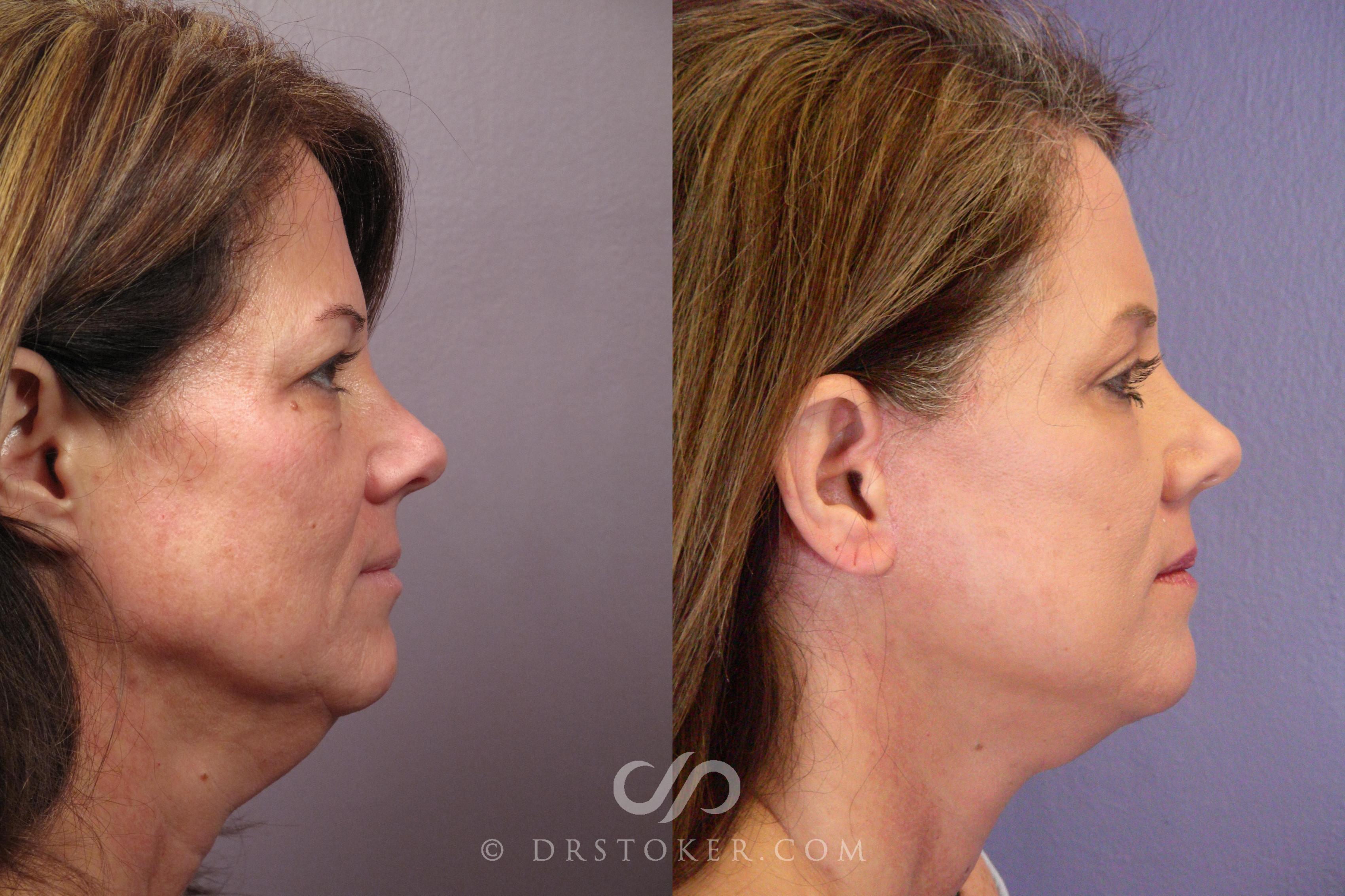 Before & After Facelift - Traceless Facelift Case 381 View #2 View in Los Angeles, CA