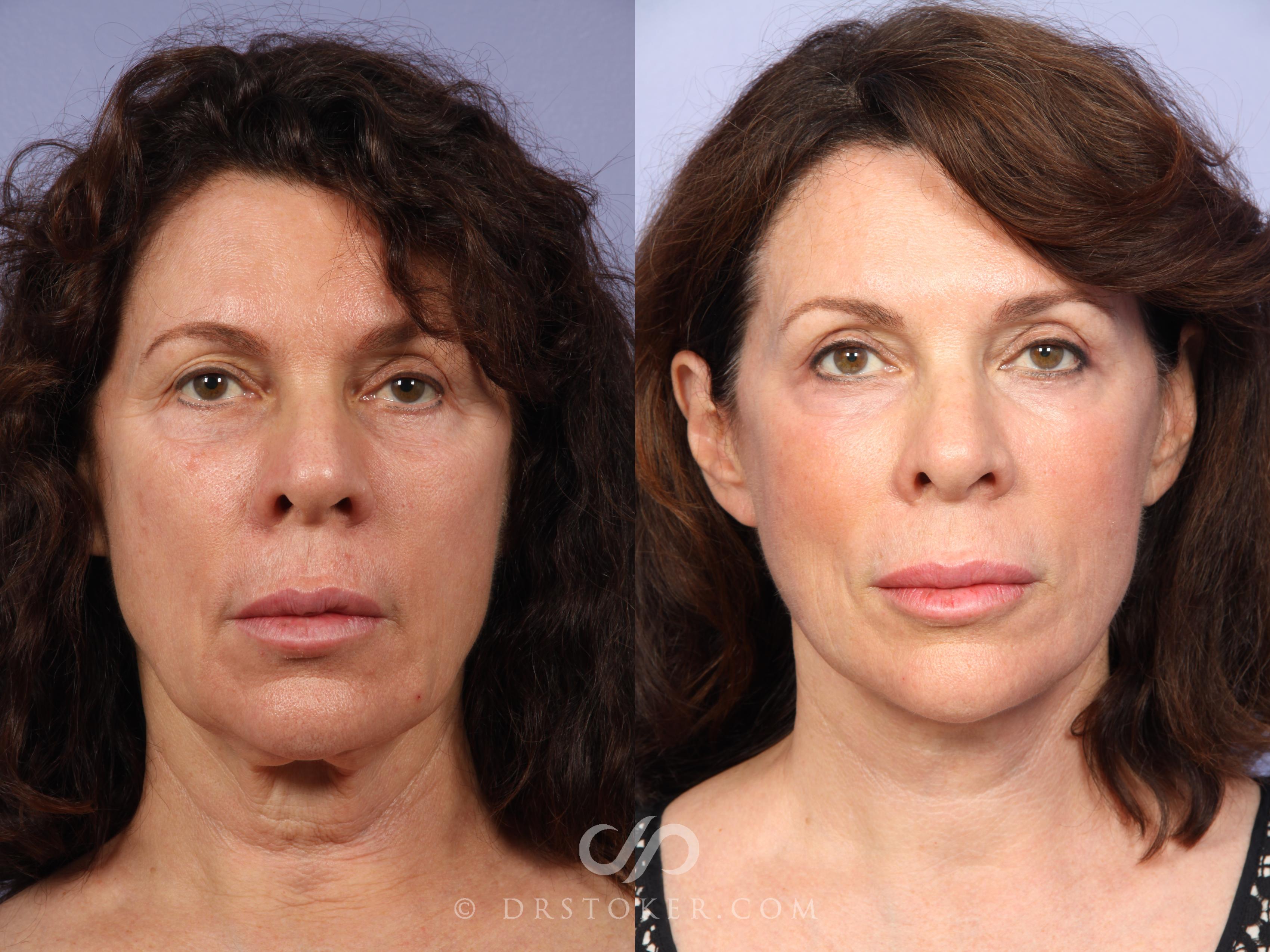 Before & After Neck Lift - Traceless Neck Lift  Case 420 View #1 View in Los Angeles, CA