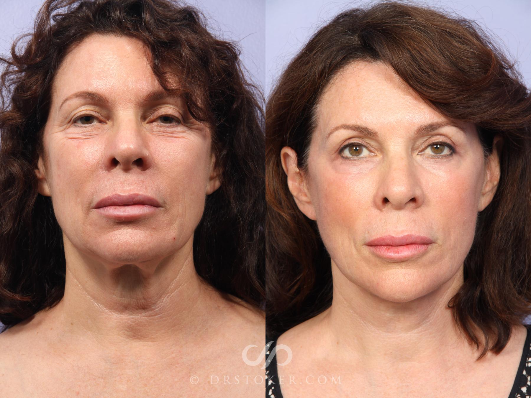 Before & After Neck Lift - Traceless Neck Lift  Case 420 View #2 View in Los Angeles, CA