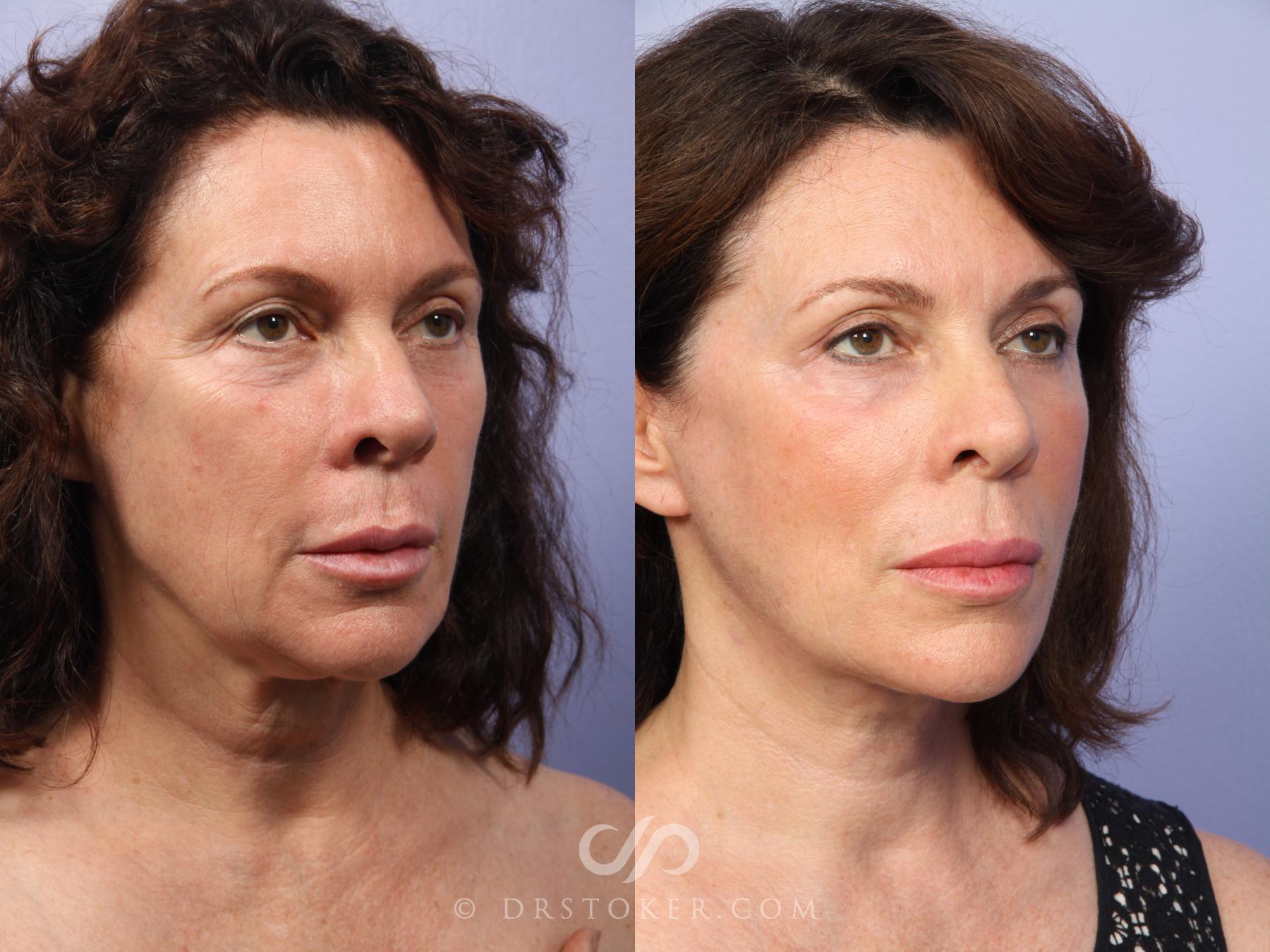 Before & After Facelift - Traceless Facelift Case 420 View #3 View in Los Angeles, CA