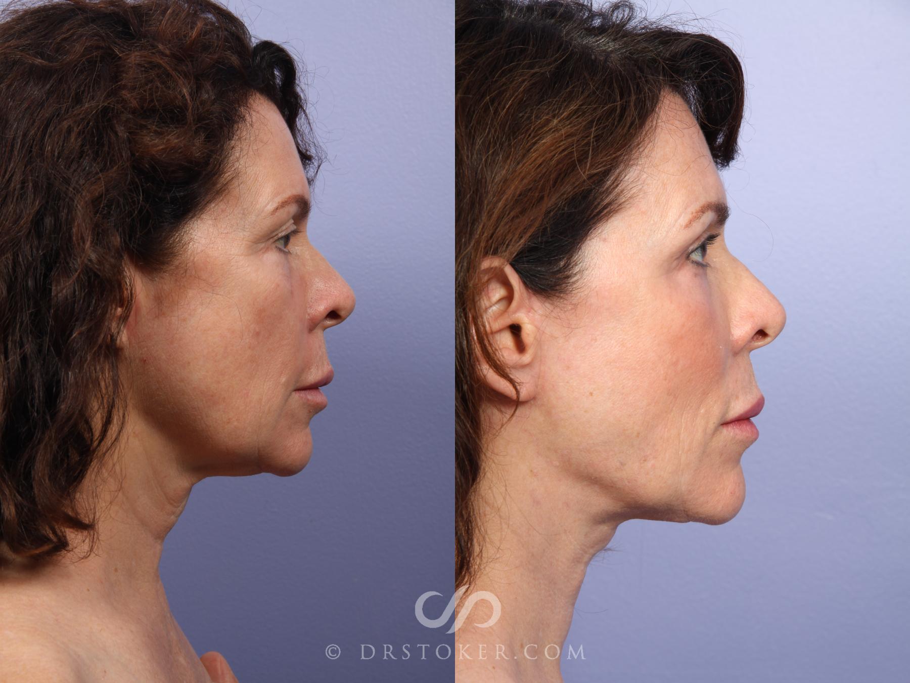 Before & After Facelift - Traceless Facelift Case 420 View #4 View in Los Angeles, CA