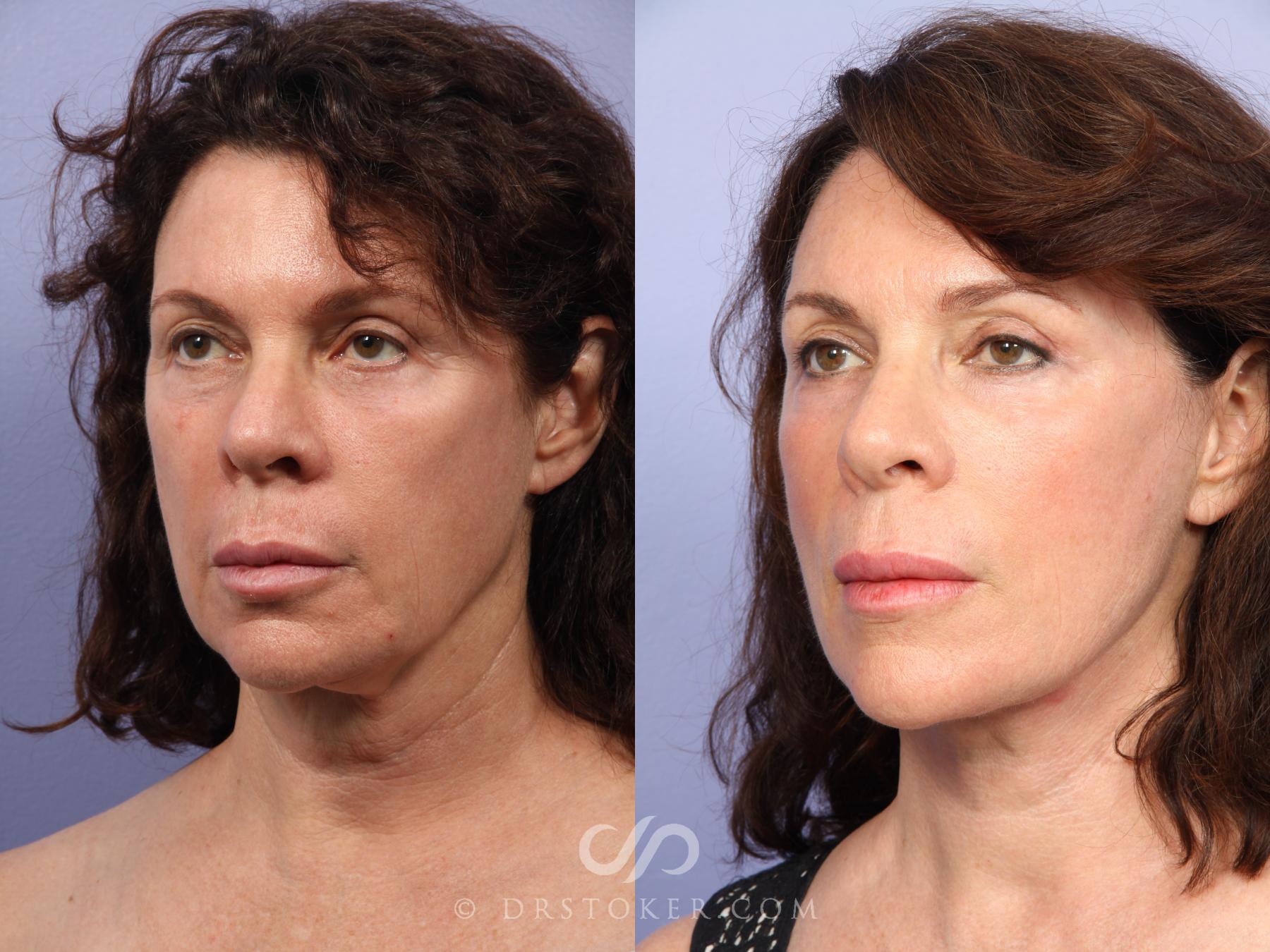 Before & After Laser Skin Resurfacing Case 420 View #5 View in Los Angeles, CA