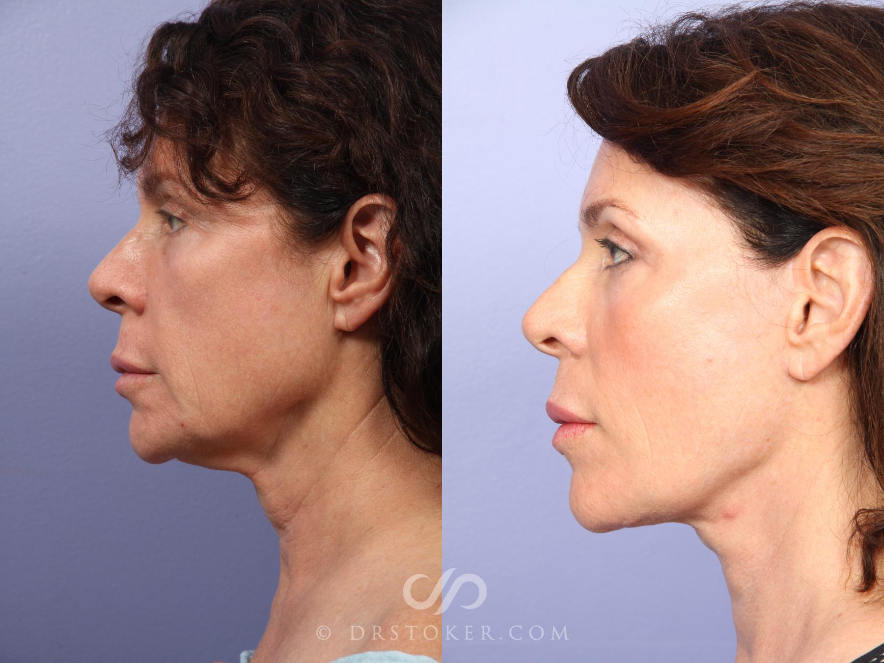 Before & After Laser Skin Resurfacing Case 420 View #6 View in Los Angeles, CA