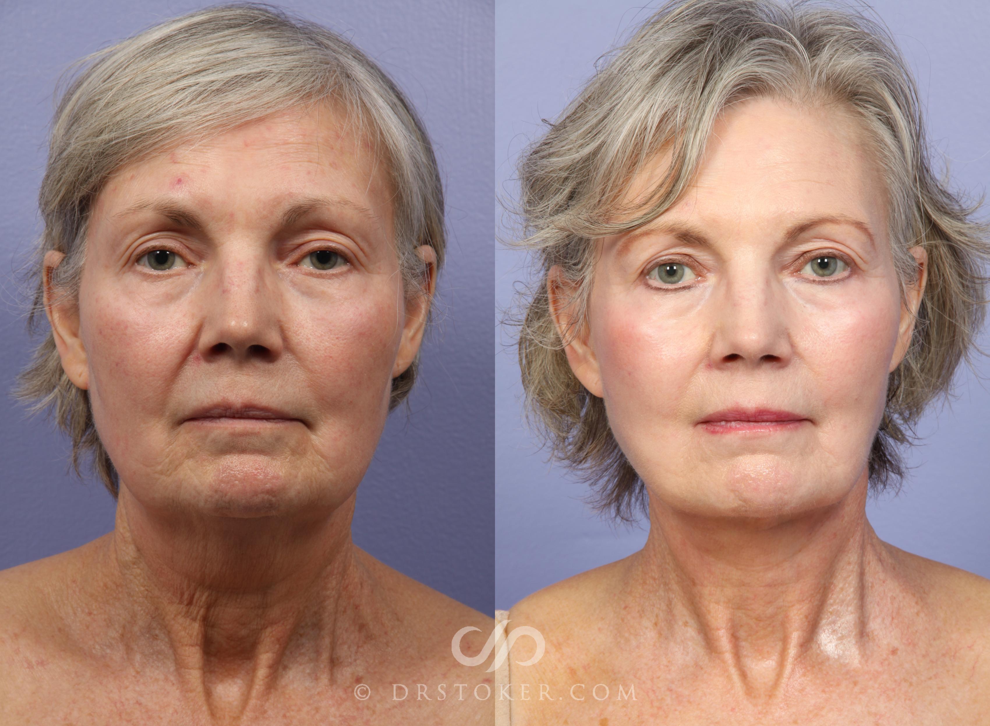 Before & After Neck Lift - Traceless Neck Lift  Case 421 View #1 View in Los Angeles, CA