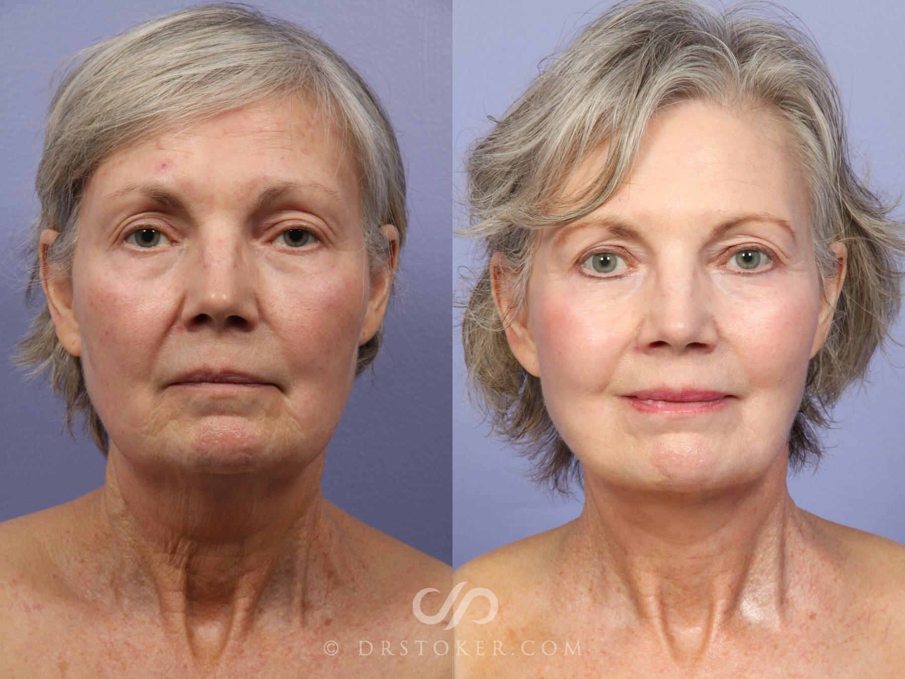 Before & After Facelift - Traceless Facelift Case 421 View #2 View in Los Angeles, CA