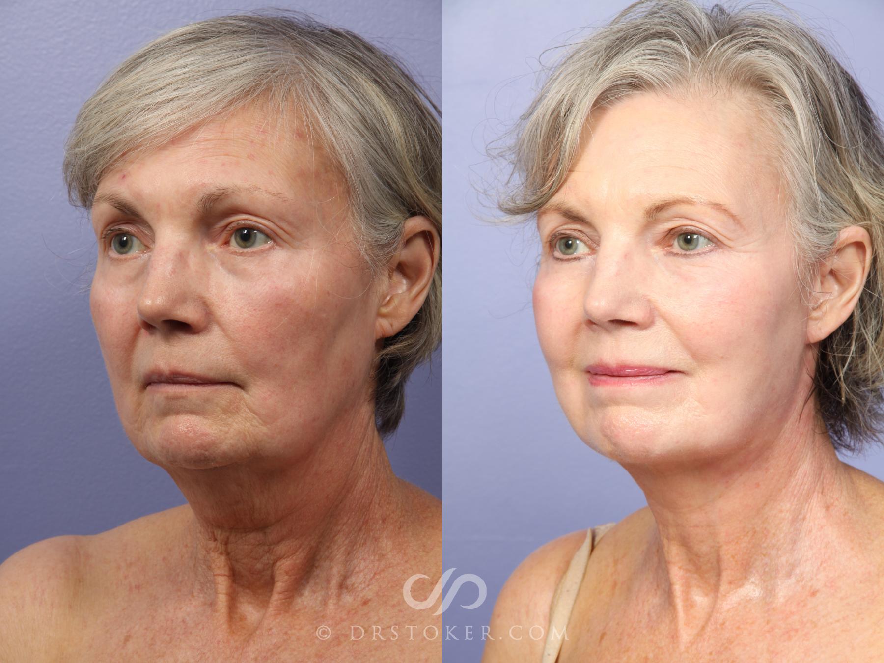 Before & After Neck Lift - Traceless Neck Lift  Case 421 View #3 View in Los Angeles, CA