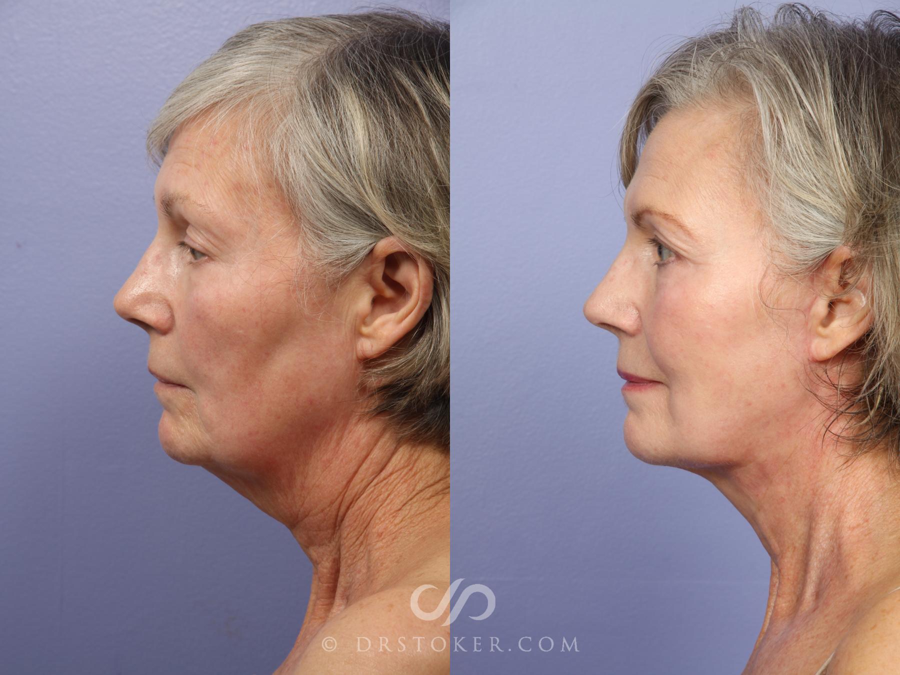 Before & After Neck Lift - Traceless Neck Lift  Case 421 View #4 View in Los Angeles, CA