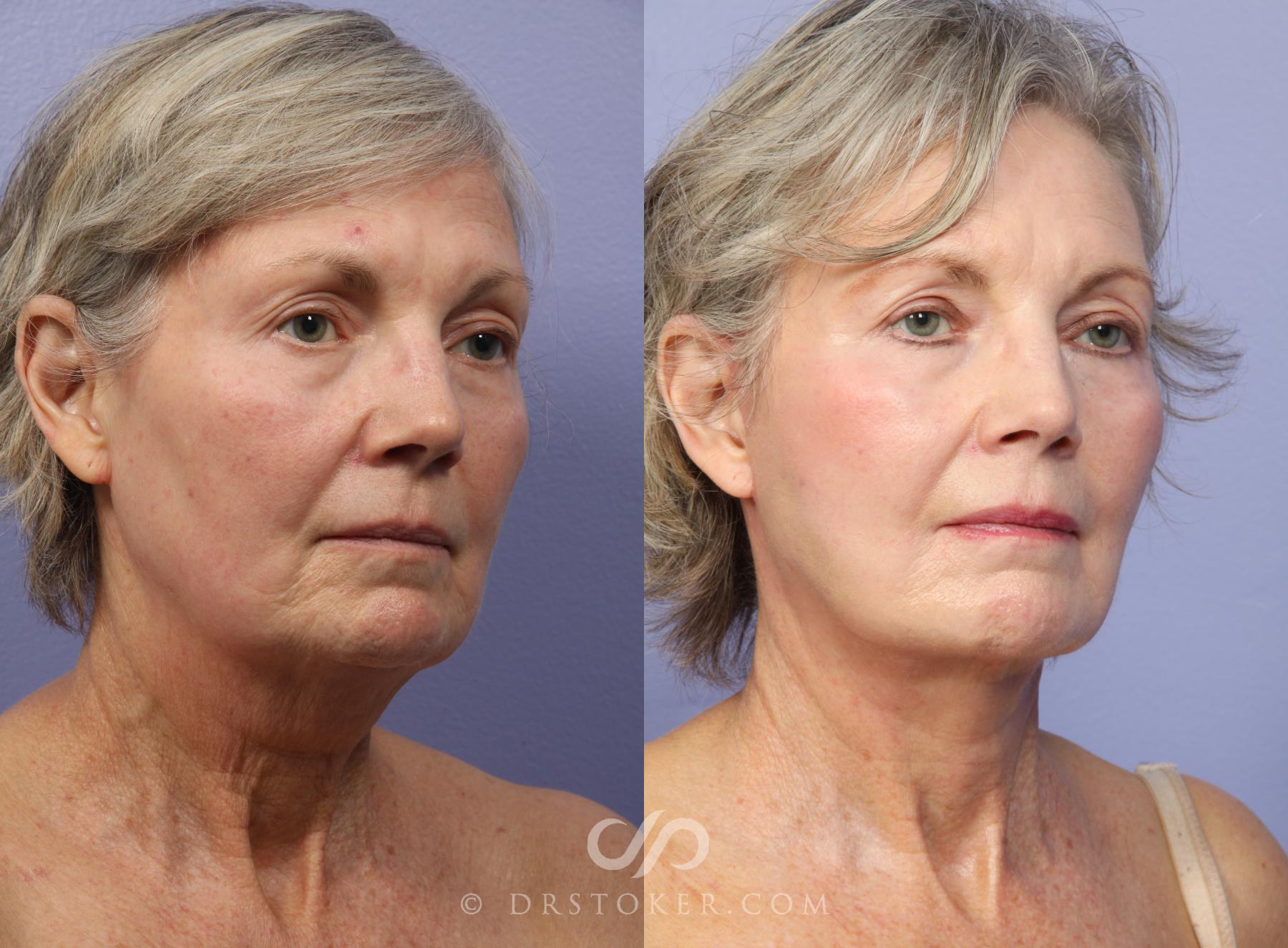 Before & After Neck Lift - Traceless Neck Lift  Case 421 View #5 View in Los Angeles, CA