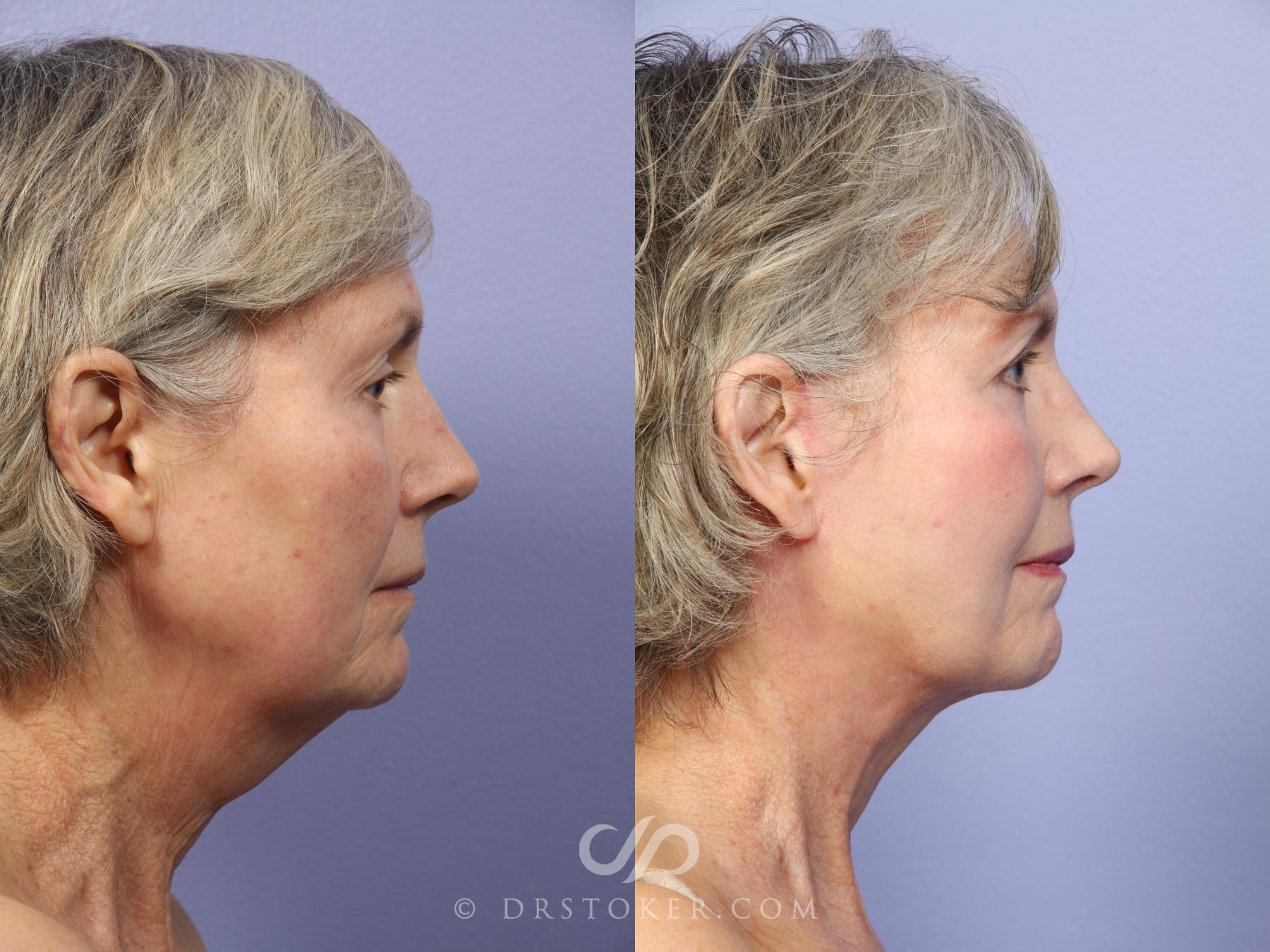 Before & After Neck Lift - Traceless Neck Lift  Case 421 View #6 View in Los Angeles, CA