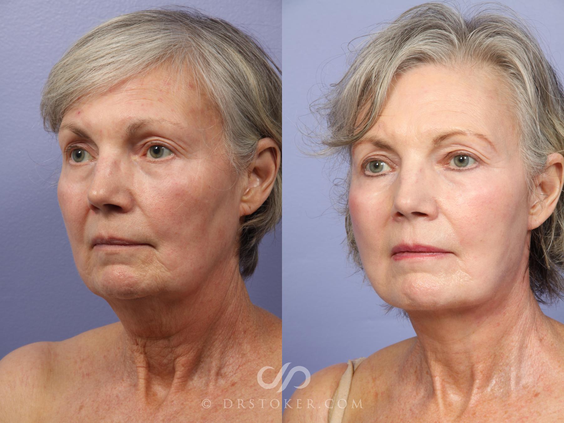Before & After Facelift - Traceless Facelift Case 421 View #7 View in Los Angeles, CA