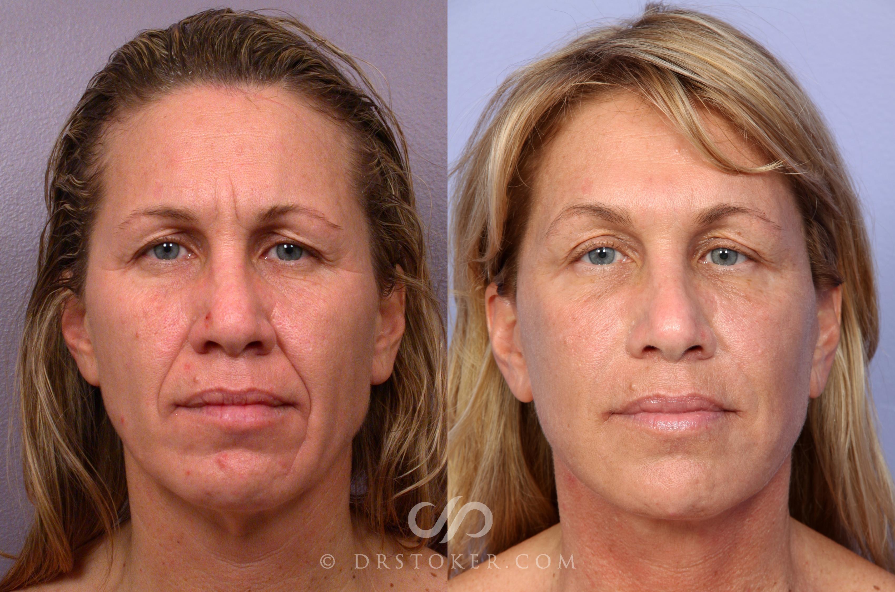 Before & After Facelift - Traceless Facelift Case 422 View #1 View in Los Angeles, CA