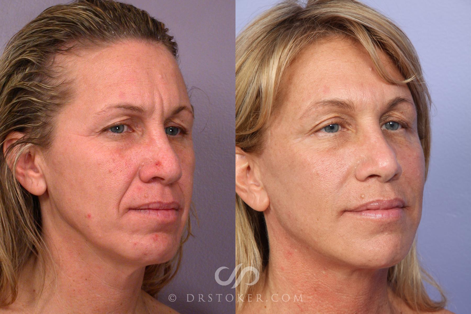 Before & After Facelift - Traceless Facelift Case 422 View #2 View in Los Angeles, CA