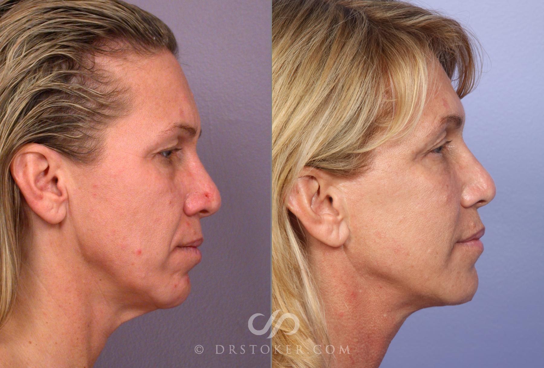 Before & After Facelift - Traceless Facelift Case 422 View #3 View in Los Angeles, CA