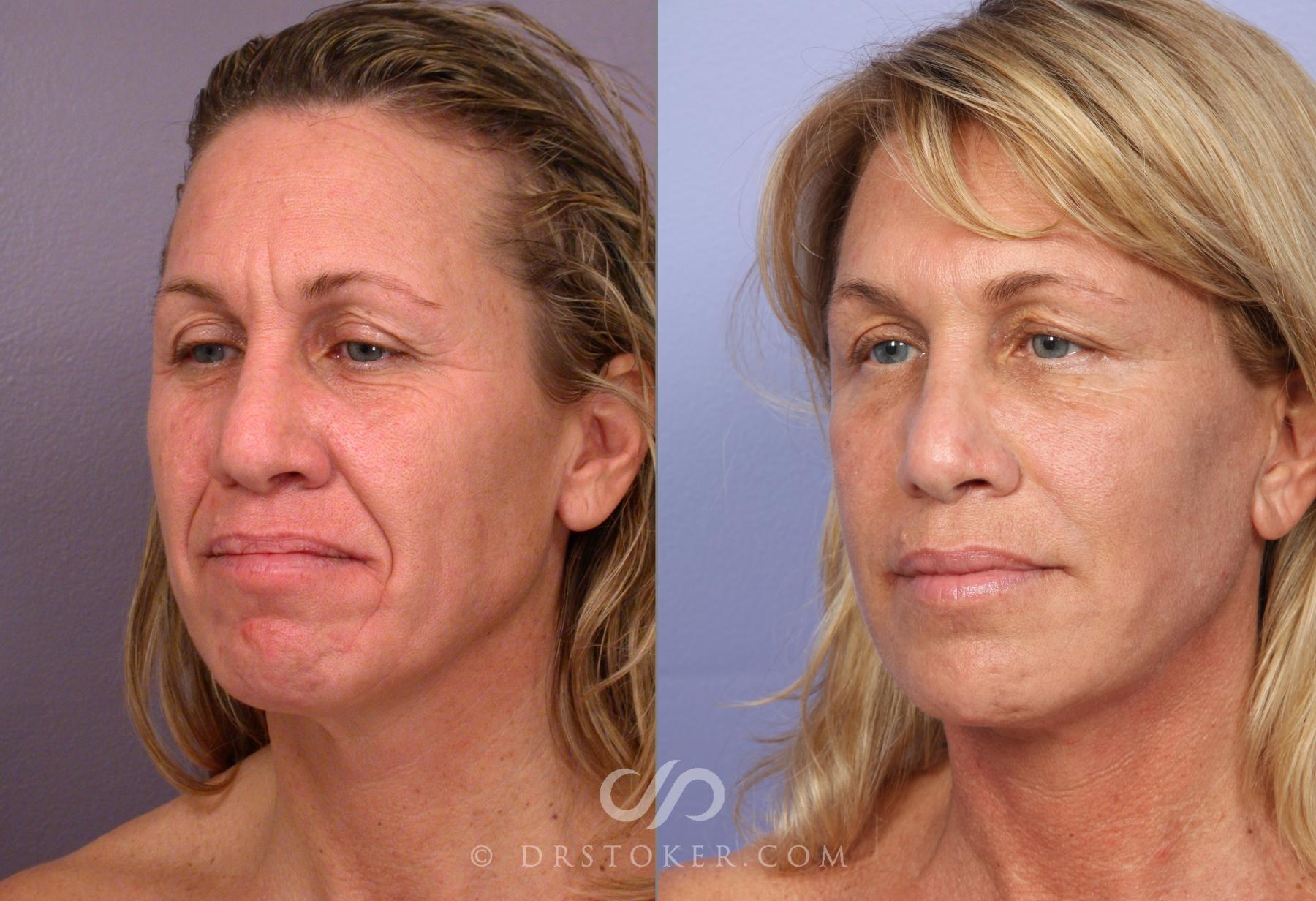Before & After Facelift - Traceless Facelift Case 422 View #4 View in Los Angeles, CA