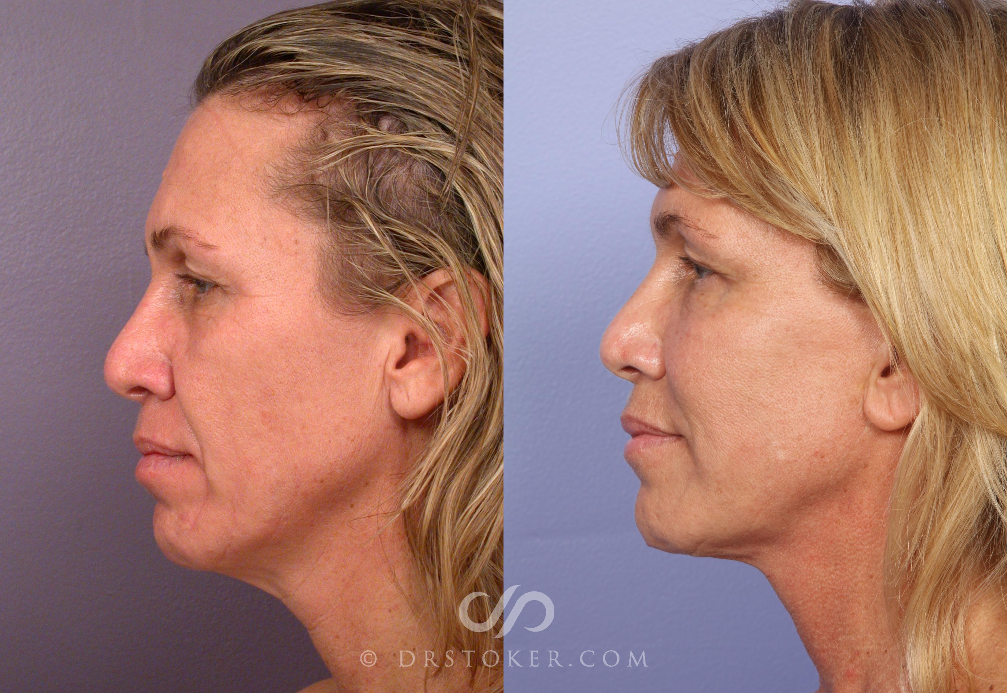 Before & After Facelift - Traceless Facelift Case 422 View #5 View in Los Angeles, CA