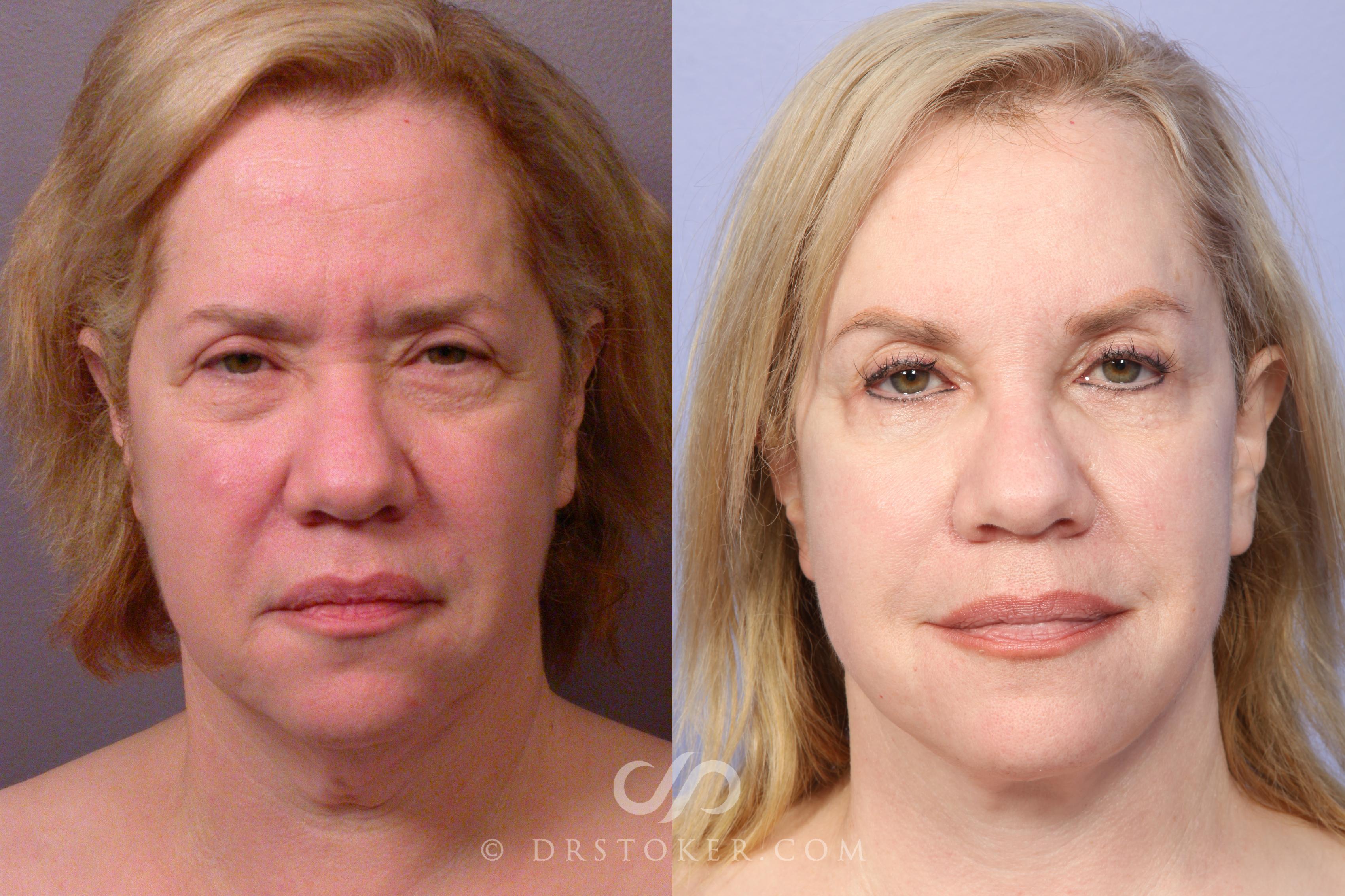 Before & After Neck Lift - Traceless Neck Lift  Case 424 View #1 View in Los Angeles, CA