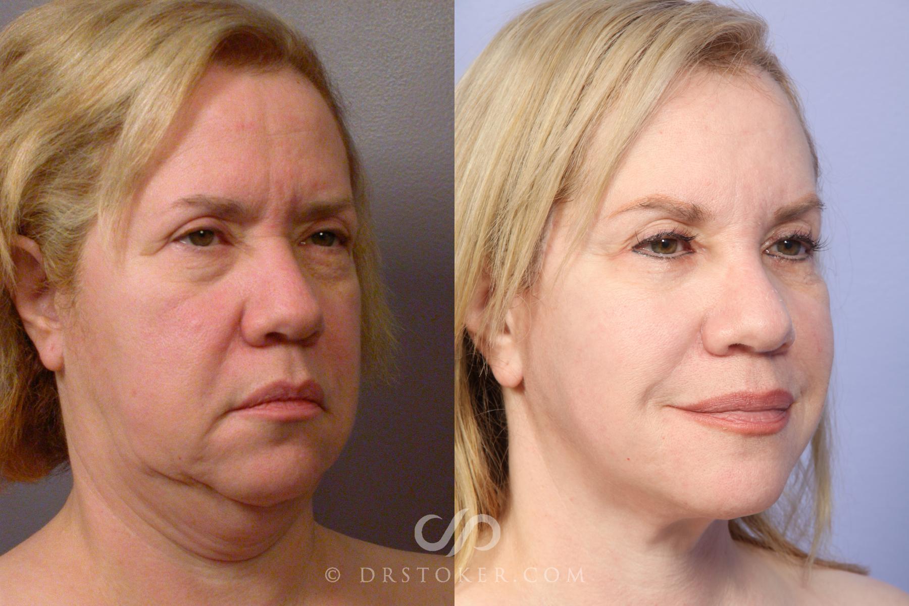 Before & After Neck Lift - Traceless Neck Lift  Case 424 View #2 View in Los Angeles, CA