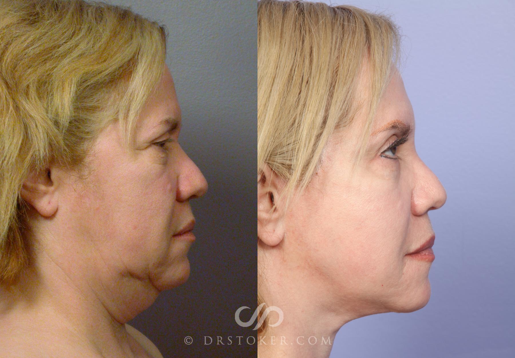 Before & After Neck Lift - Traceless Neck Lift  Case 424 View #3 View in Los Angeles, CA