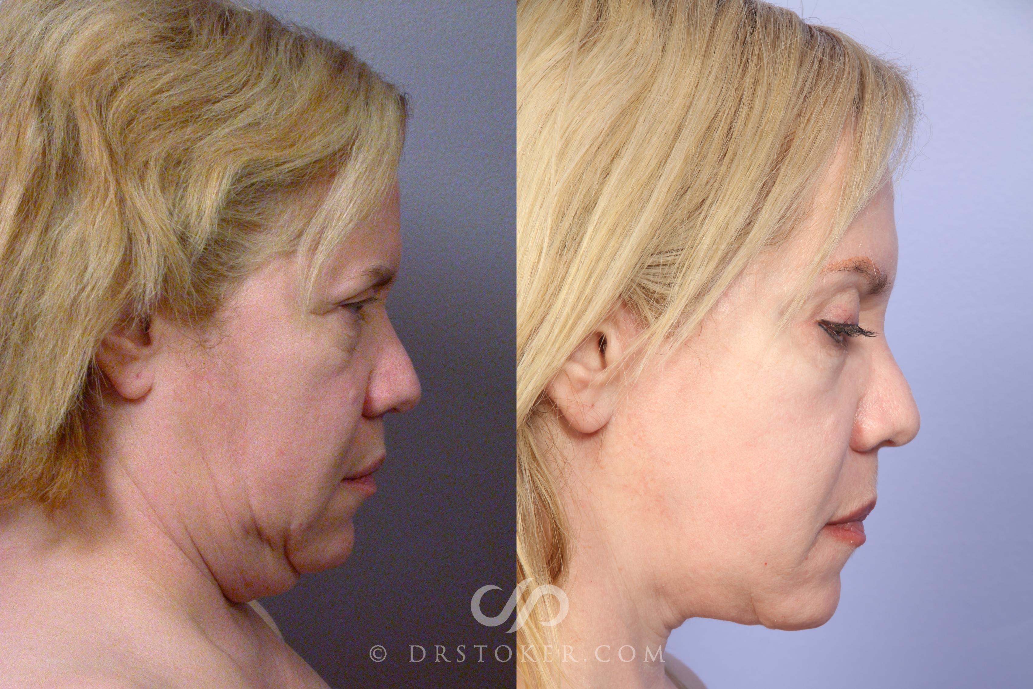 Before & After Facelift - Traceless Facelift Case 424 View #4 View in Los Angeles, CA