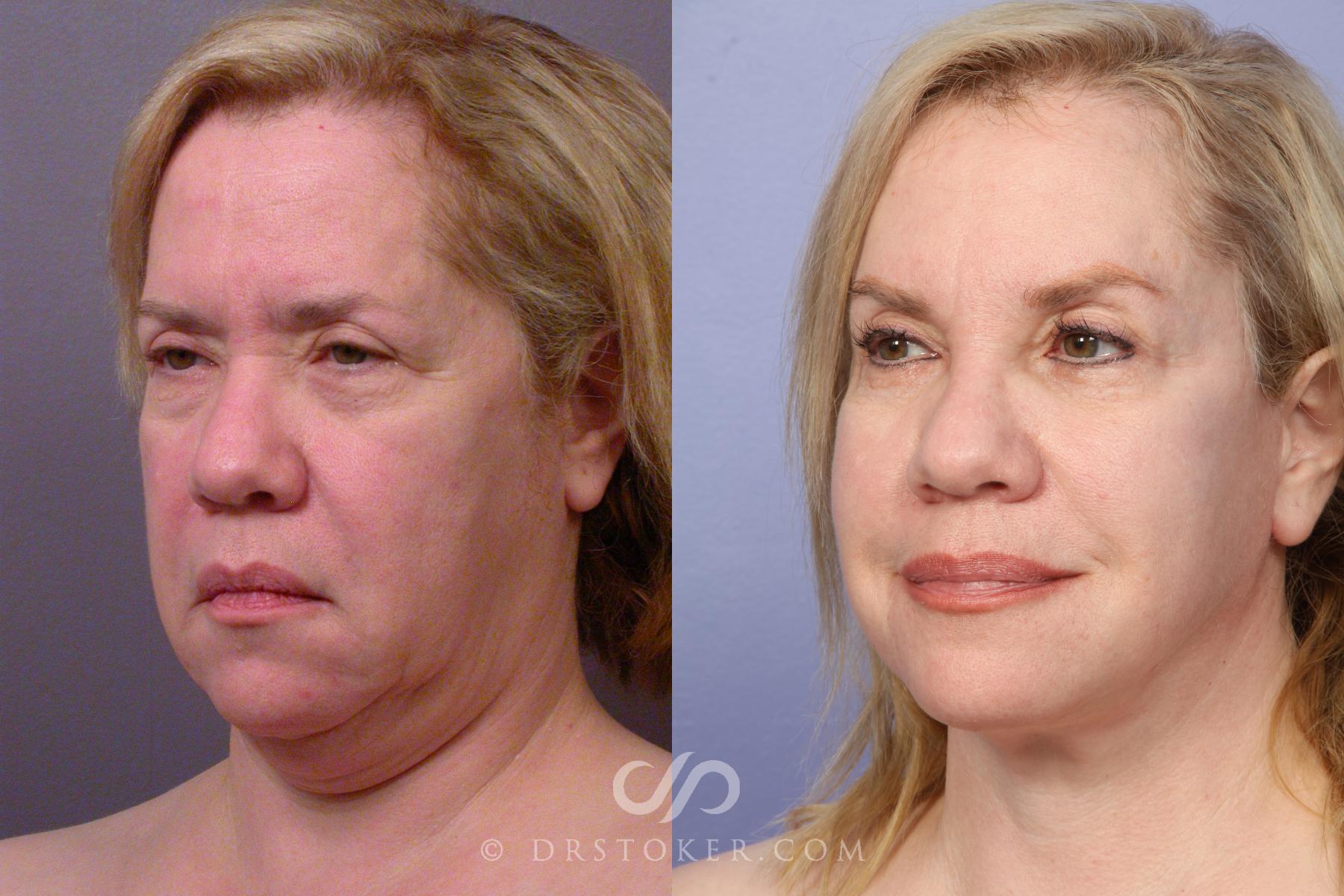 Before & After Facelift - Traceless Facelift Case 424 View #5 View in Los Angeles, CA