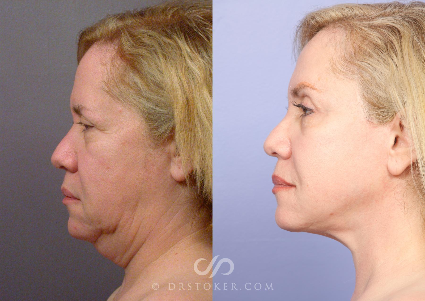 Before & After Neck Lift - Traceless Neck Lift  Case 424 View #6 View in Los Angeles, CA