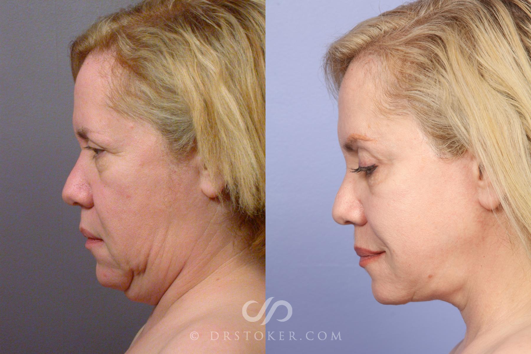 Before & After Neck Lift - Traceless Neck Lift  Case 424 View #7 View in Los Angeles, CA