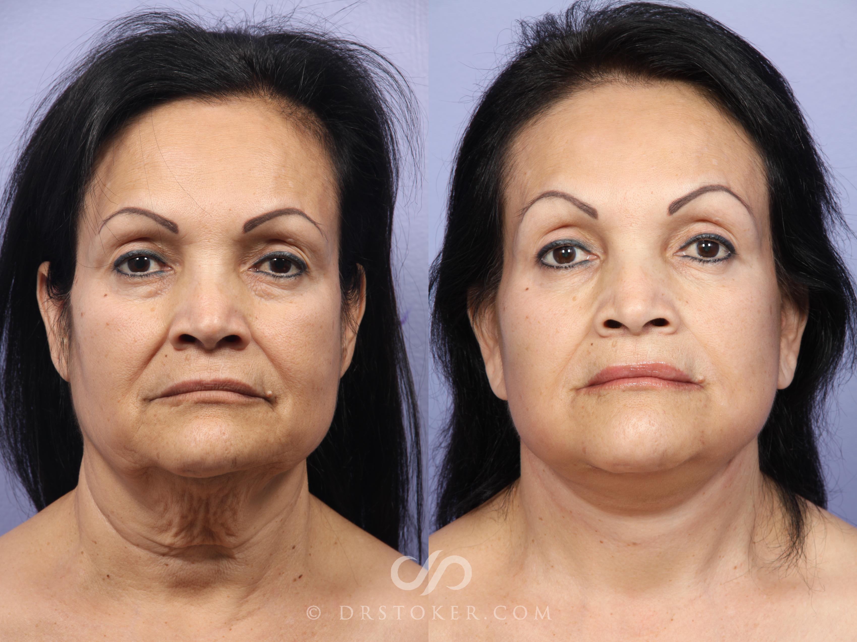 Before & After Facelift - Traceless Facelift Case 474 View #1 View in Los Angeles, CA