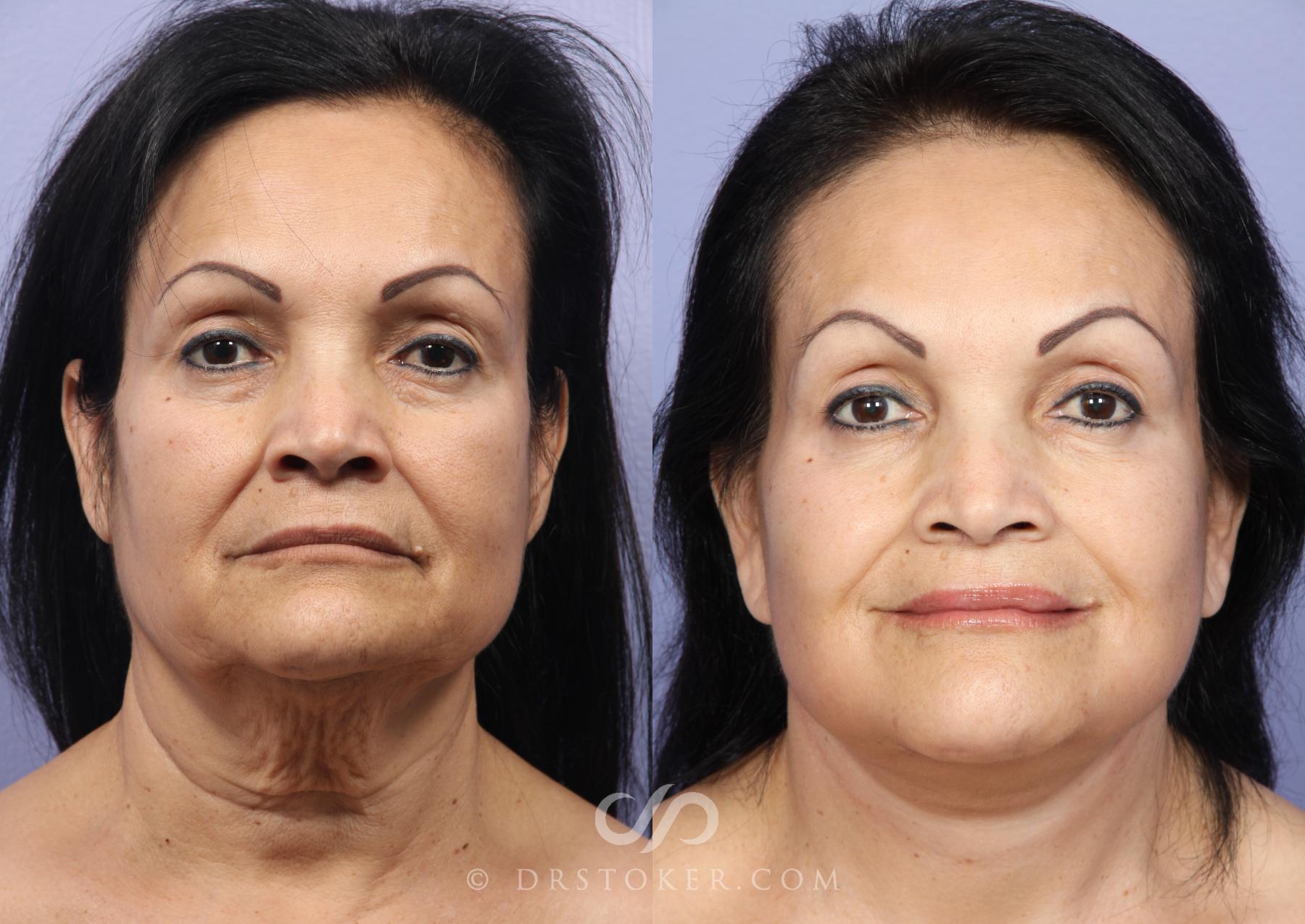 Before & After Facelift - Traceless Facelift Case 474 View #2 View in Los Angeles, CA