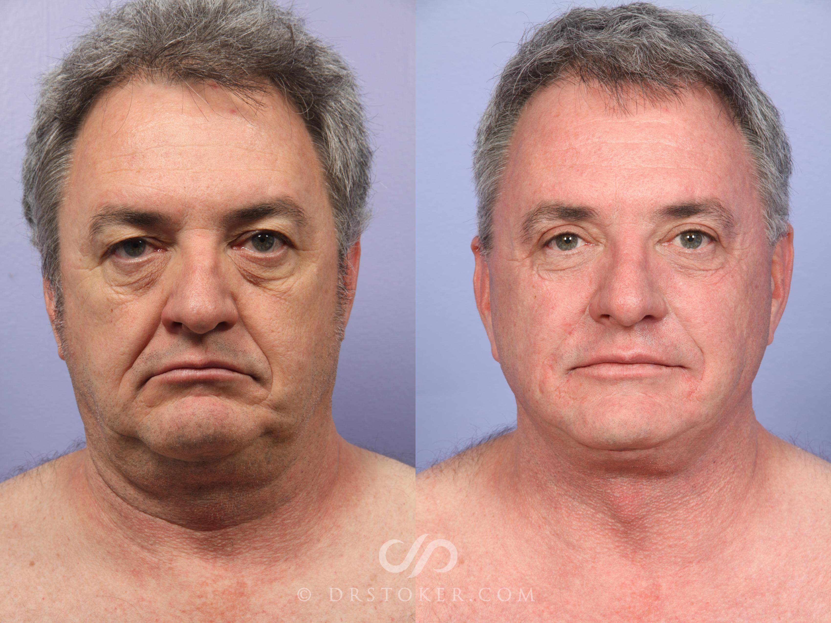 Before & After Neck Lift for Men Case 493 View #1 View in Marina del Rey, CA