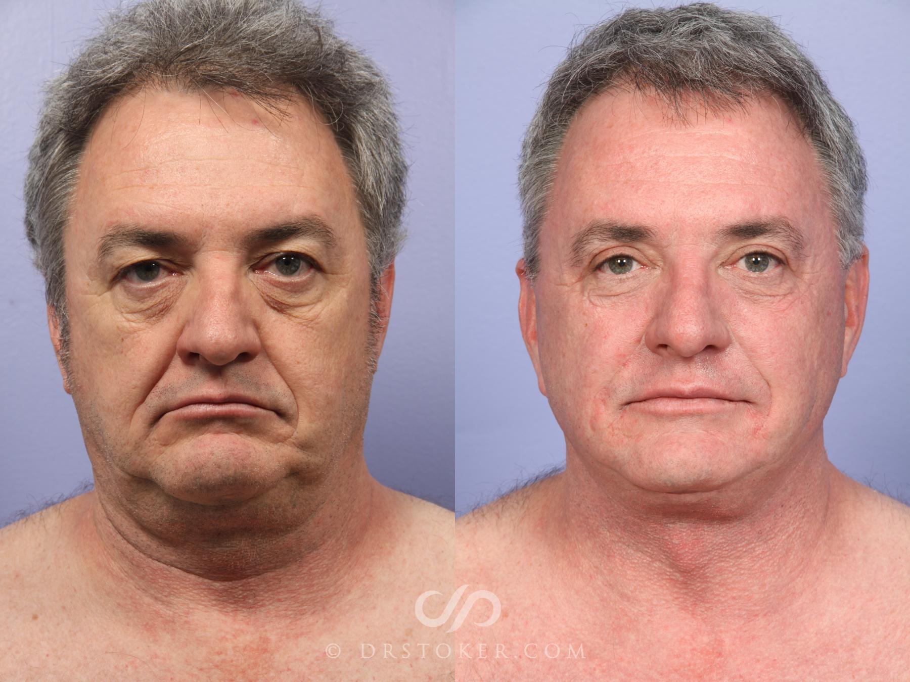 Before & After Laser Skin Resurfacing Case 493 View #1 View in Los Angeles, CA