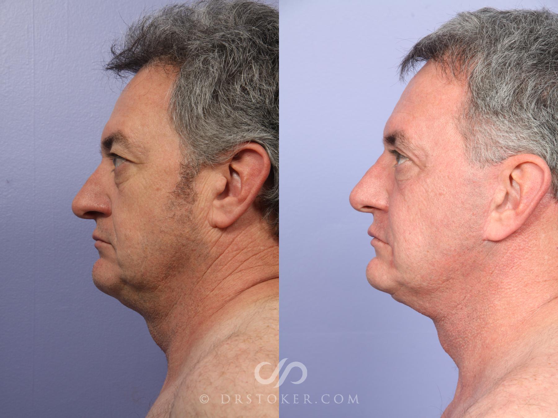 Before & After Neck Lift - Traceless Neck Lift  Case 493 View #4 View in Los Angeles, CA