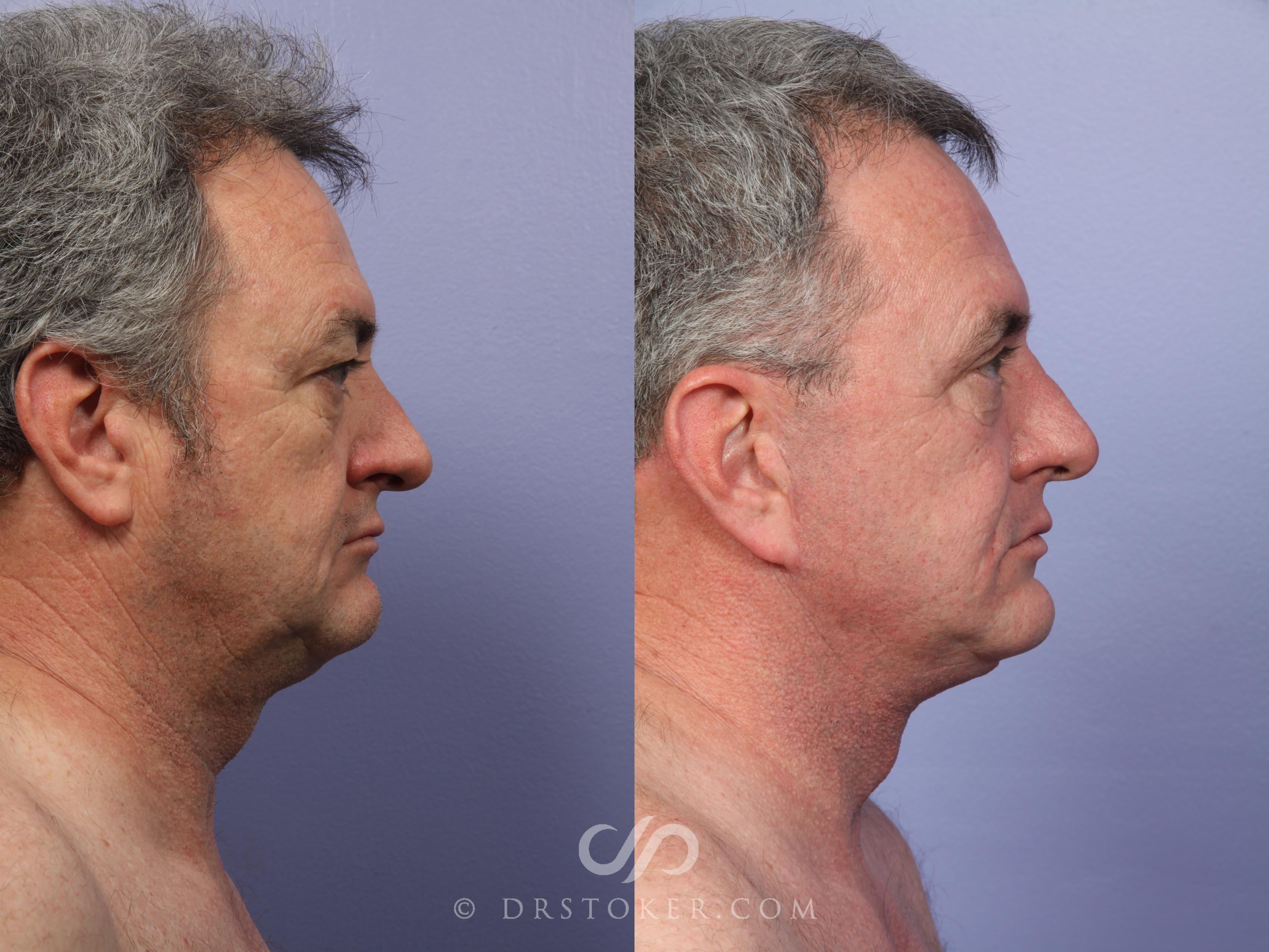 Before & After Laser Skin Resurfacing Case 493 View #5 View in Los Angeles, CA