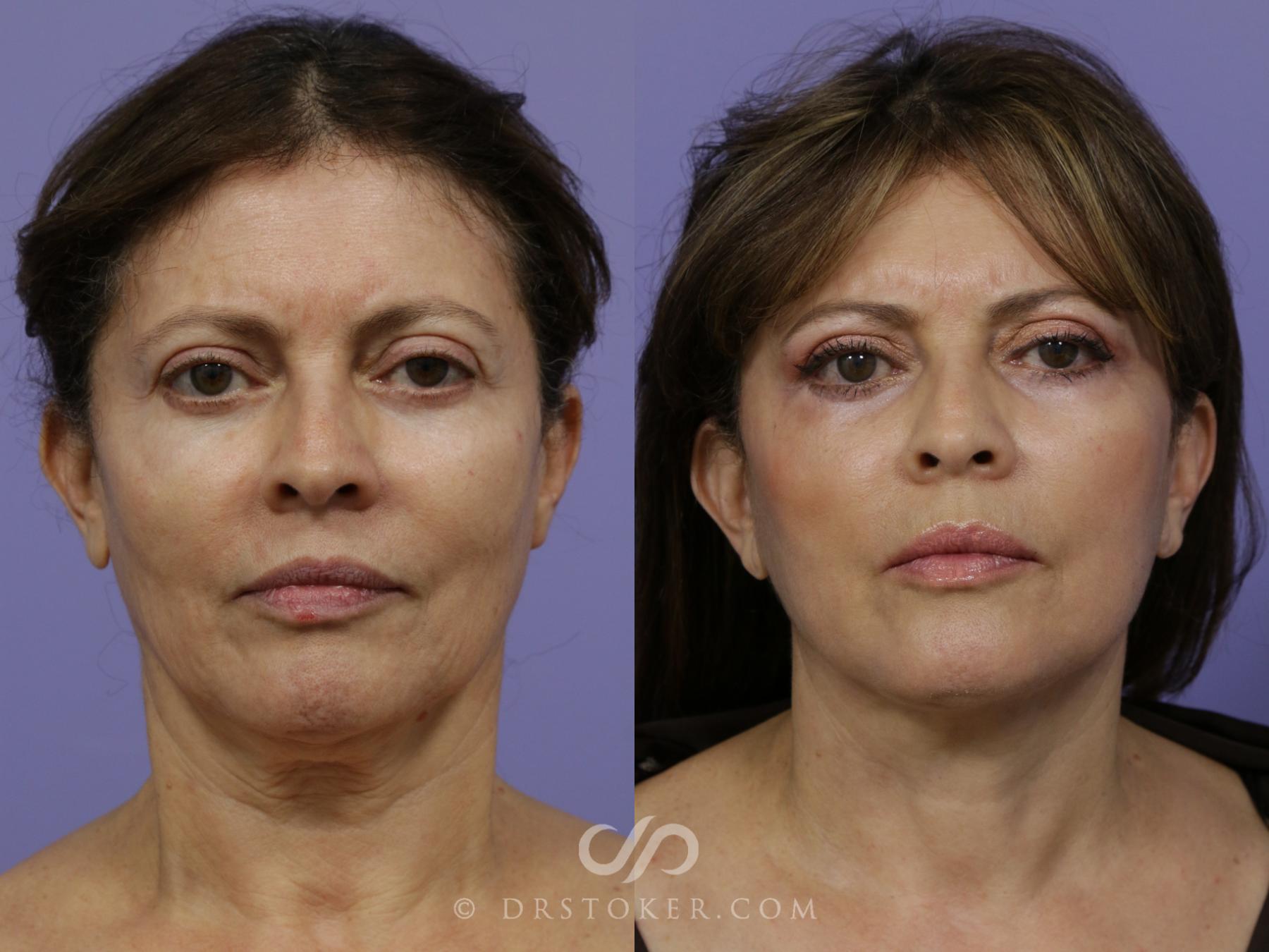Before & After Facelift - Traceless Facelift Case 792 View #1 View in Los Angeles, CA