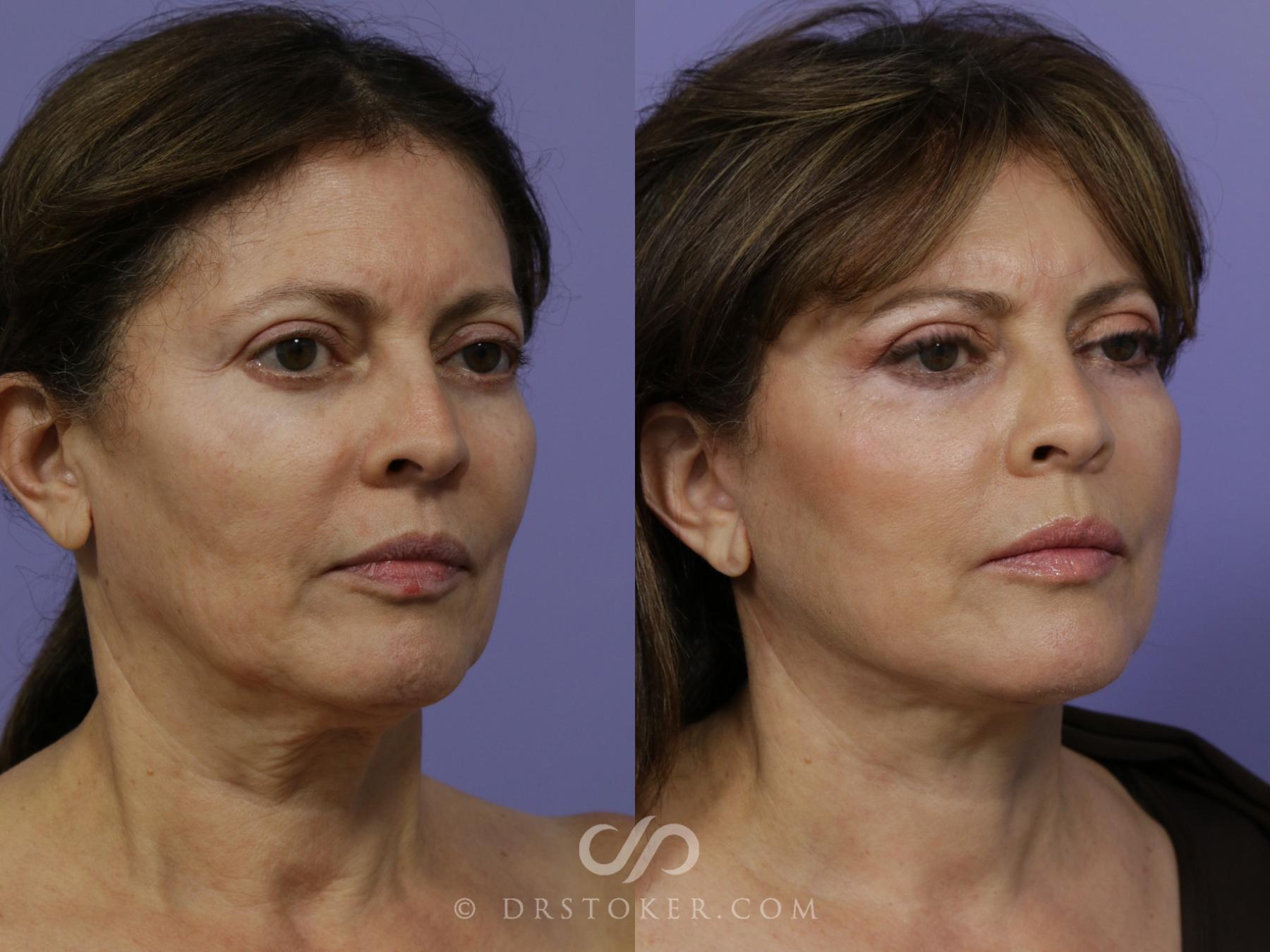 Before & After Facelift - Traceless Facelift Case 792 View #2 View in Los Angeles, CA