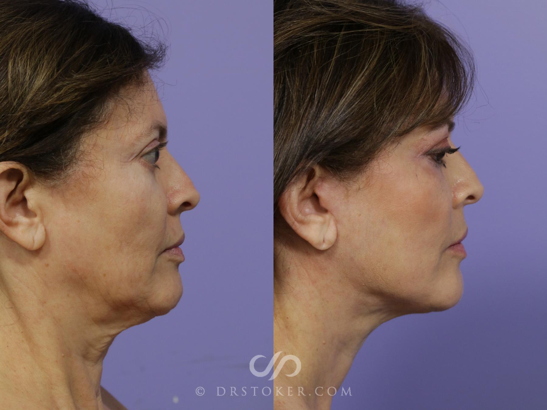 Before & After Facelift - Traceless Facelift Case 792 View #3 View in Los Angeles, CA