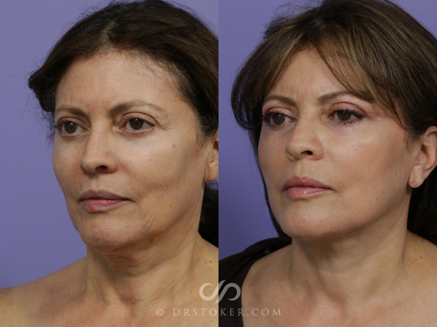 Before & After Facelift - Traceless Facelift Case 792 View #4 View in Los Angeles, CA