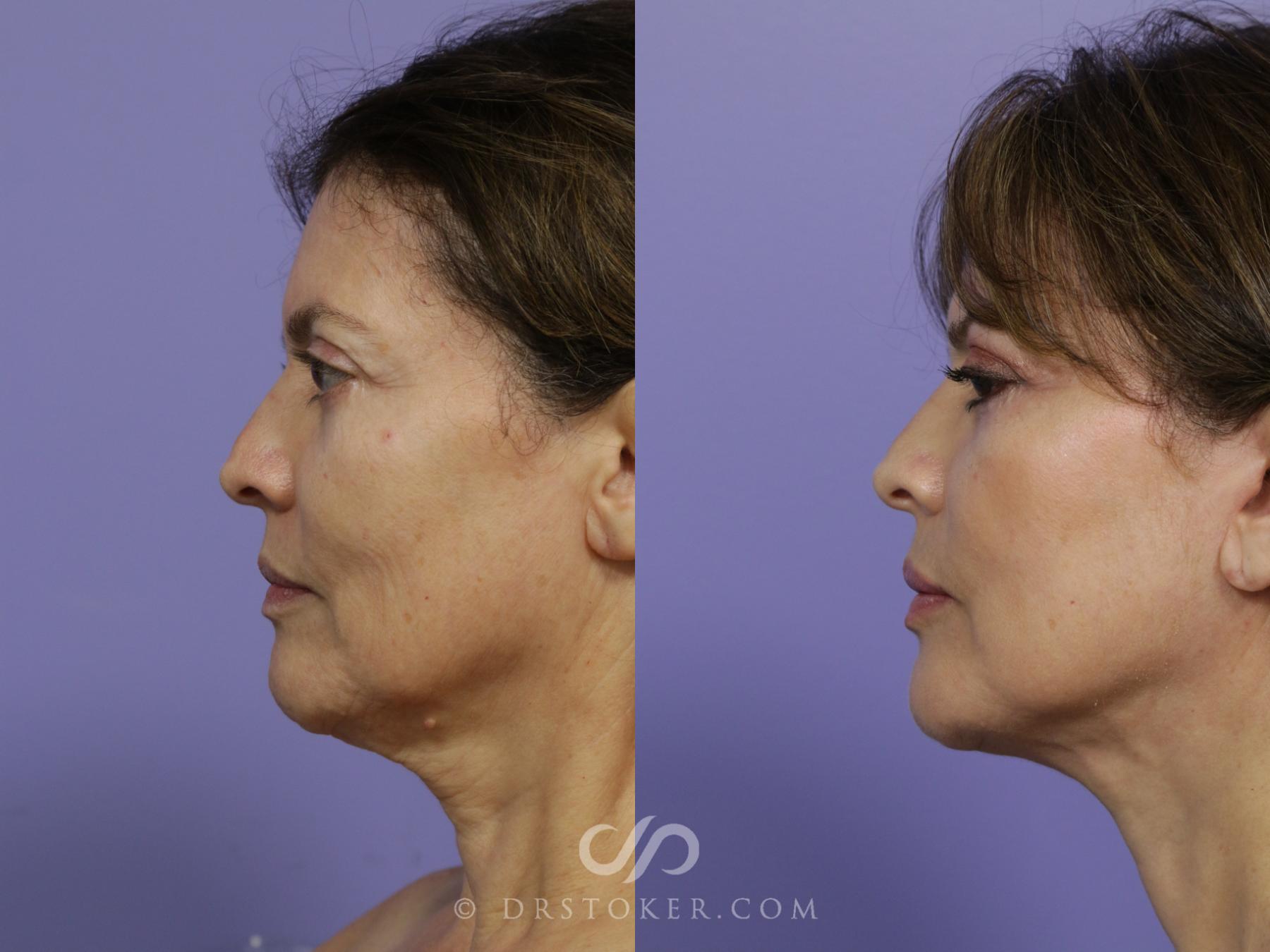 Before & After Facelift - Traceless Facelift Case 792 View #5 View in Los Angeles, CA