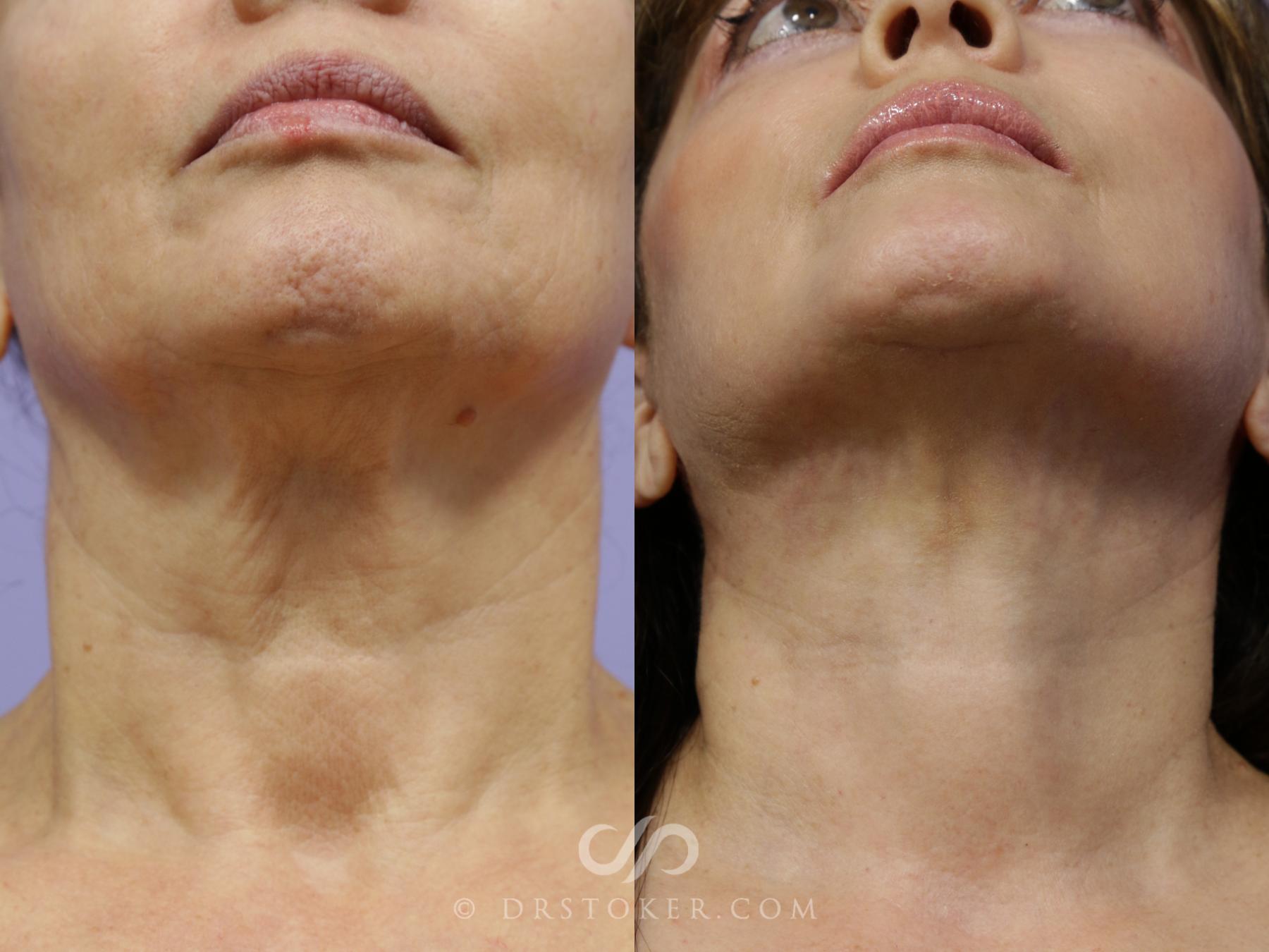 Before & After Facelift - Traceless Facelift Case 792 View #6 View in Los Angeles, CA