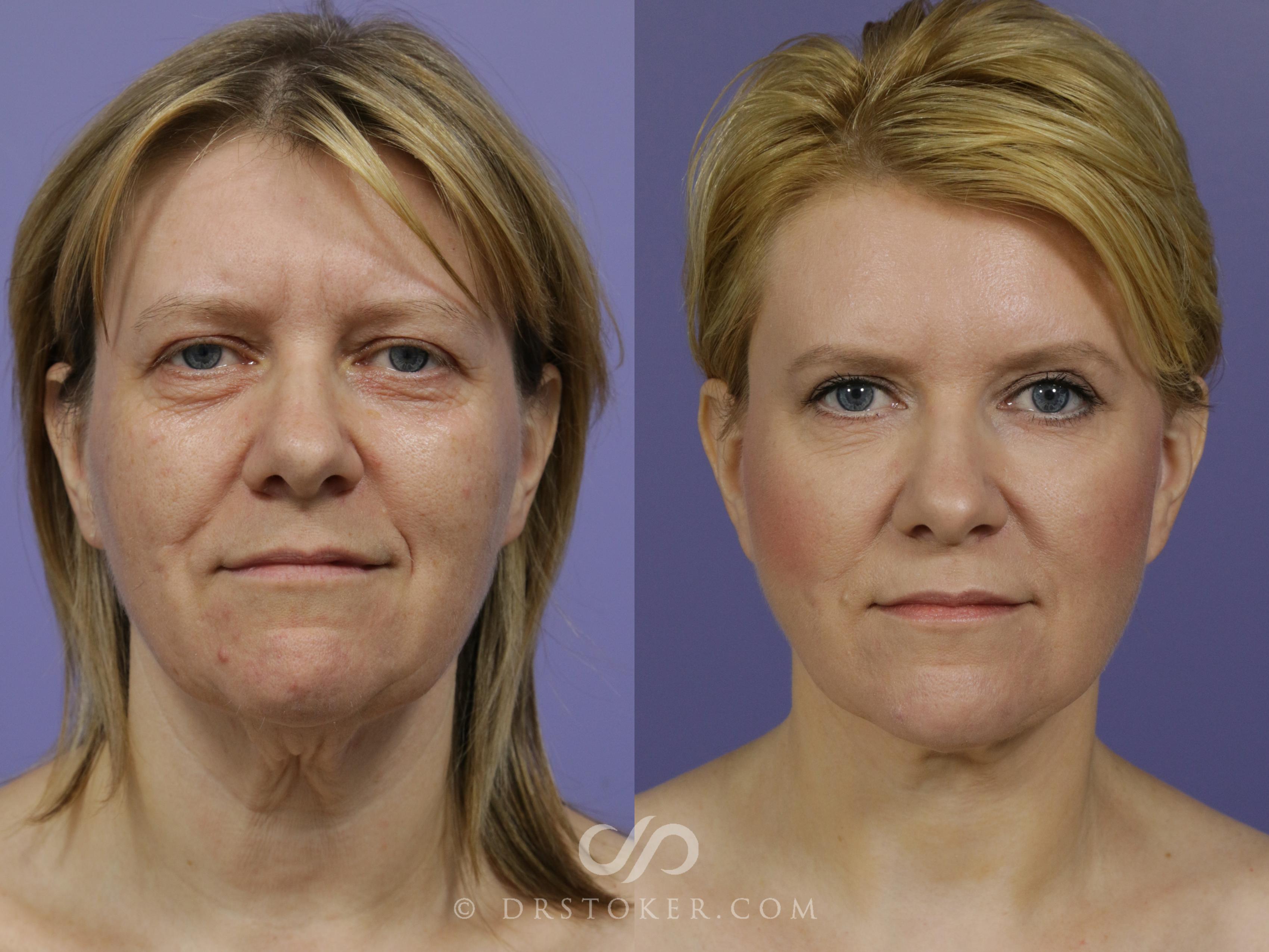 Before & After Deep Plane Facelift/Neck Lift - Traceless Deep Plane Facelift Case 796 View #1 View in Los Angeles, CA