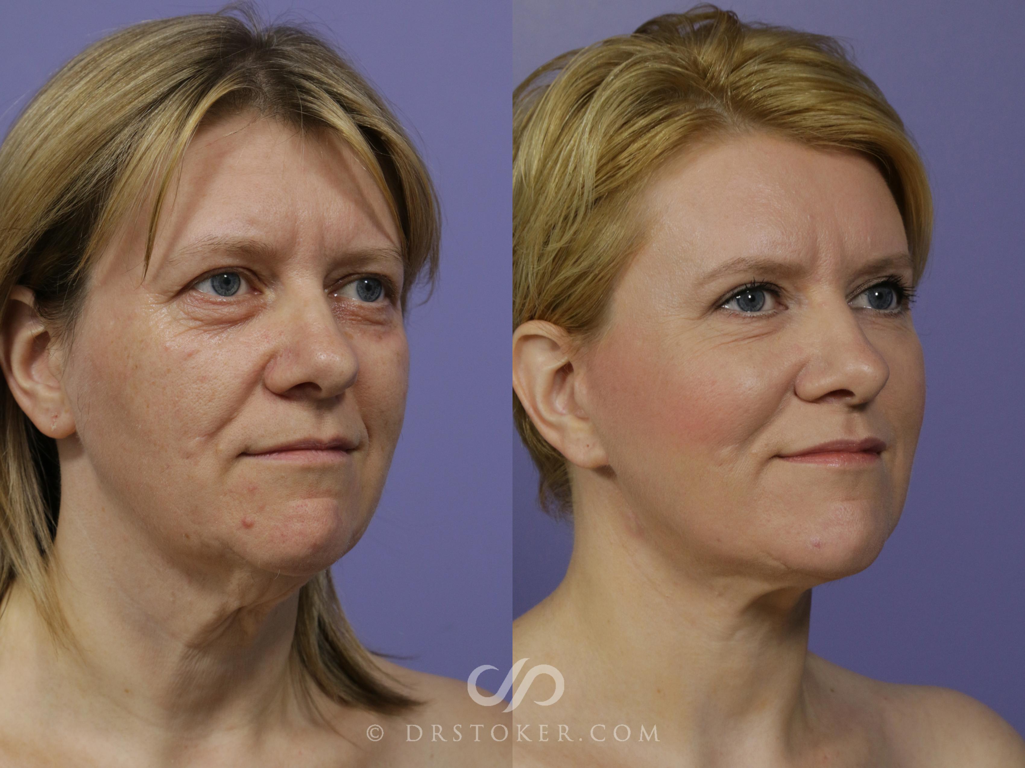 Before & After Facelift - Traceless Facelift Case 796 View #2 View in Los Angeles, CA