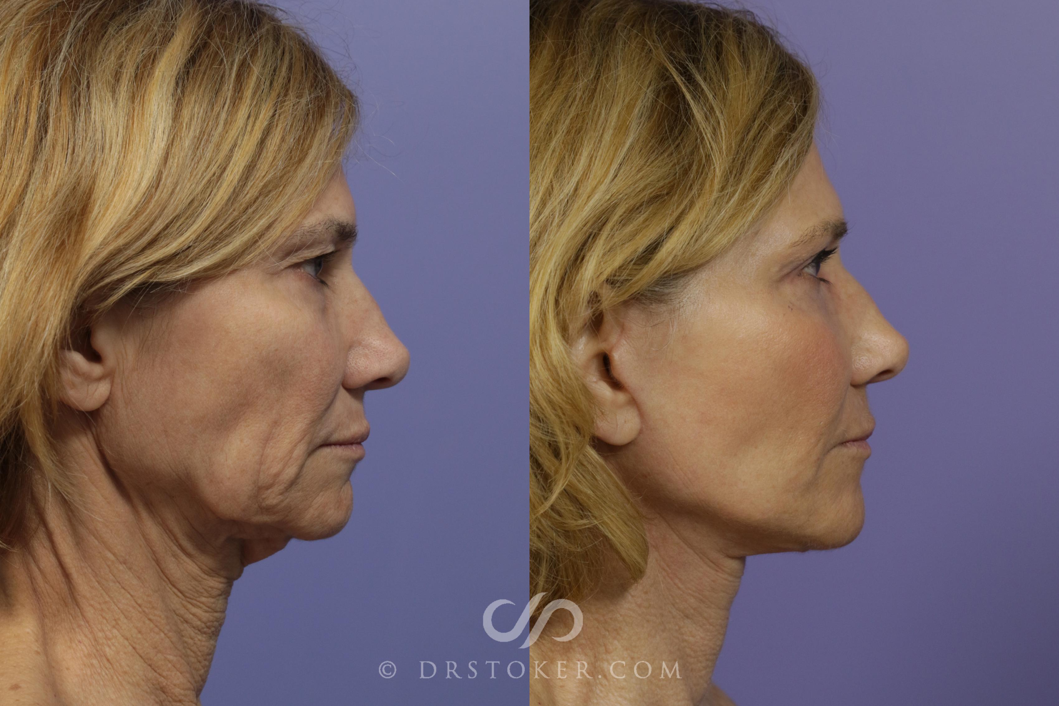 Before & After Facelift - Traceless Facelift Case 798 View #2 View in Los Angeles, CA