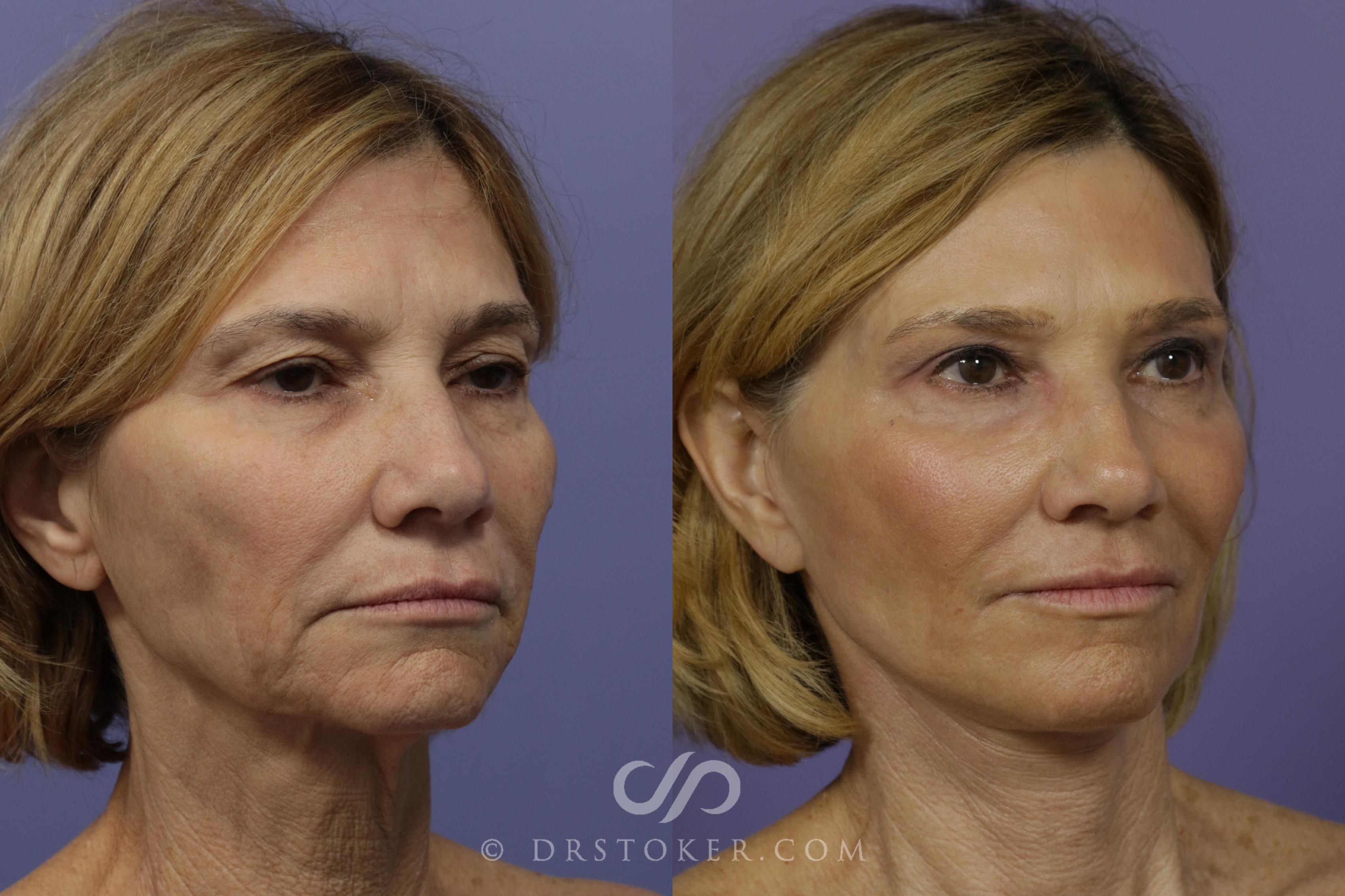 Before & After Facelift - Traceless Facelift Case 798 View #4 View in Los Angeles, CA