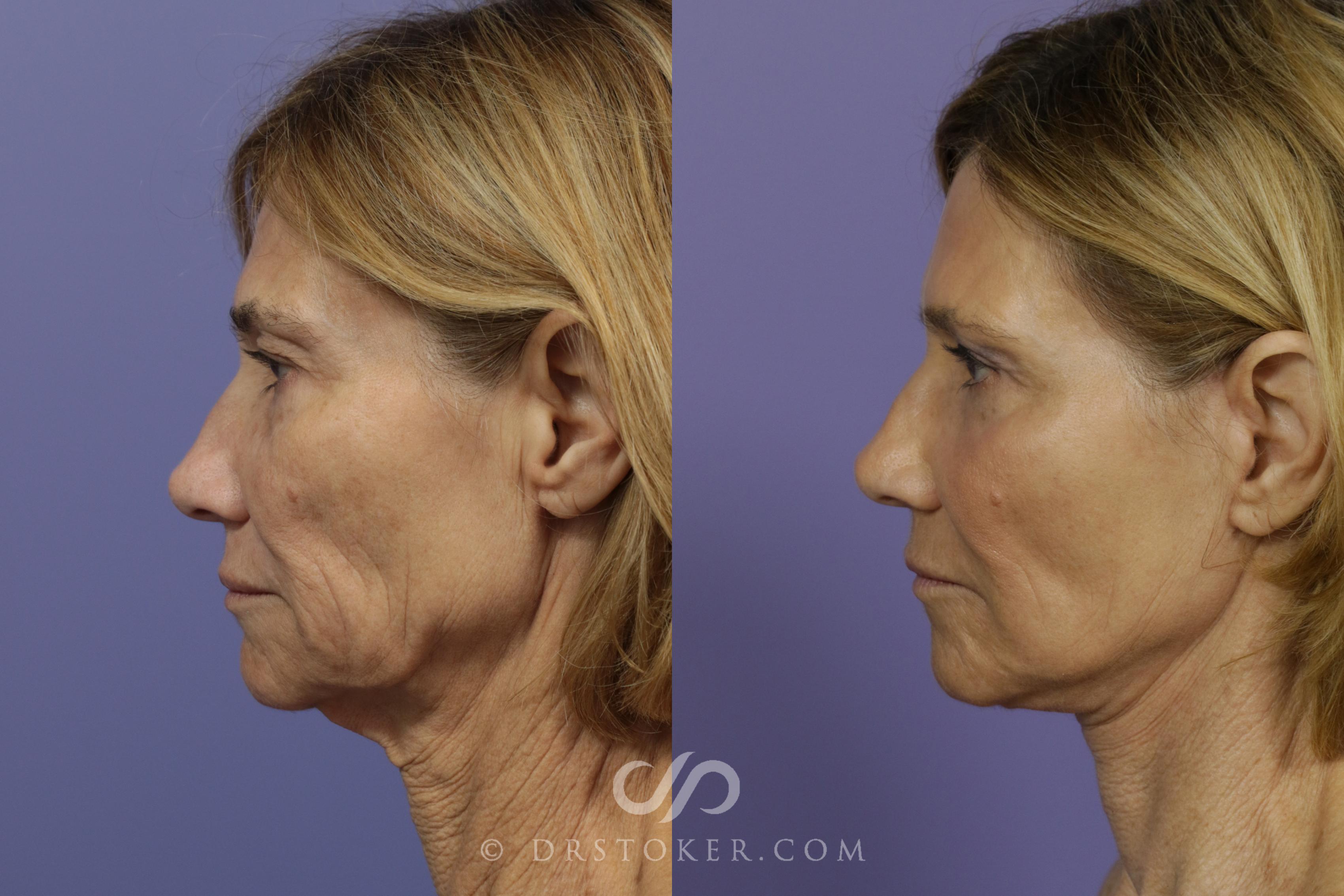 Before & After Facelift - Traceless Facelift Case 798 View #5 View in Los Angeles, CA