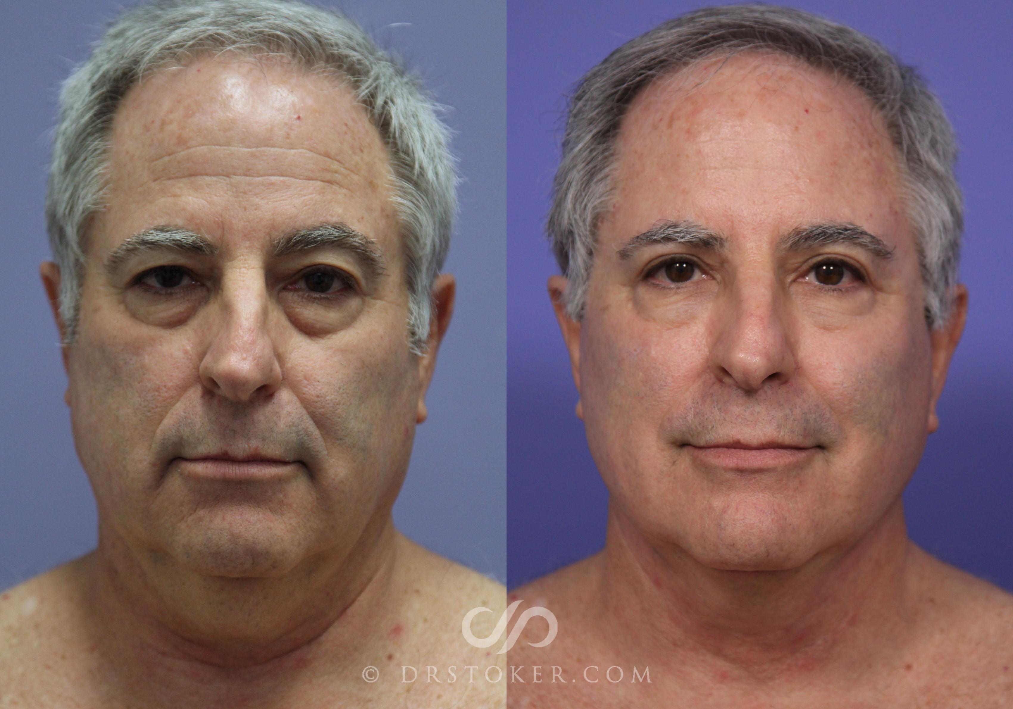 Before & After Neck Lift for Men Case 807 View #1 View in Marina del Rey, CA