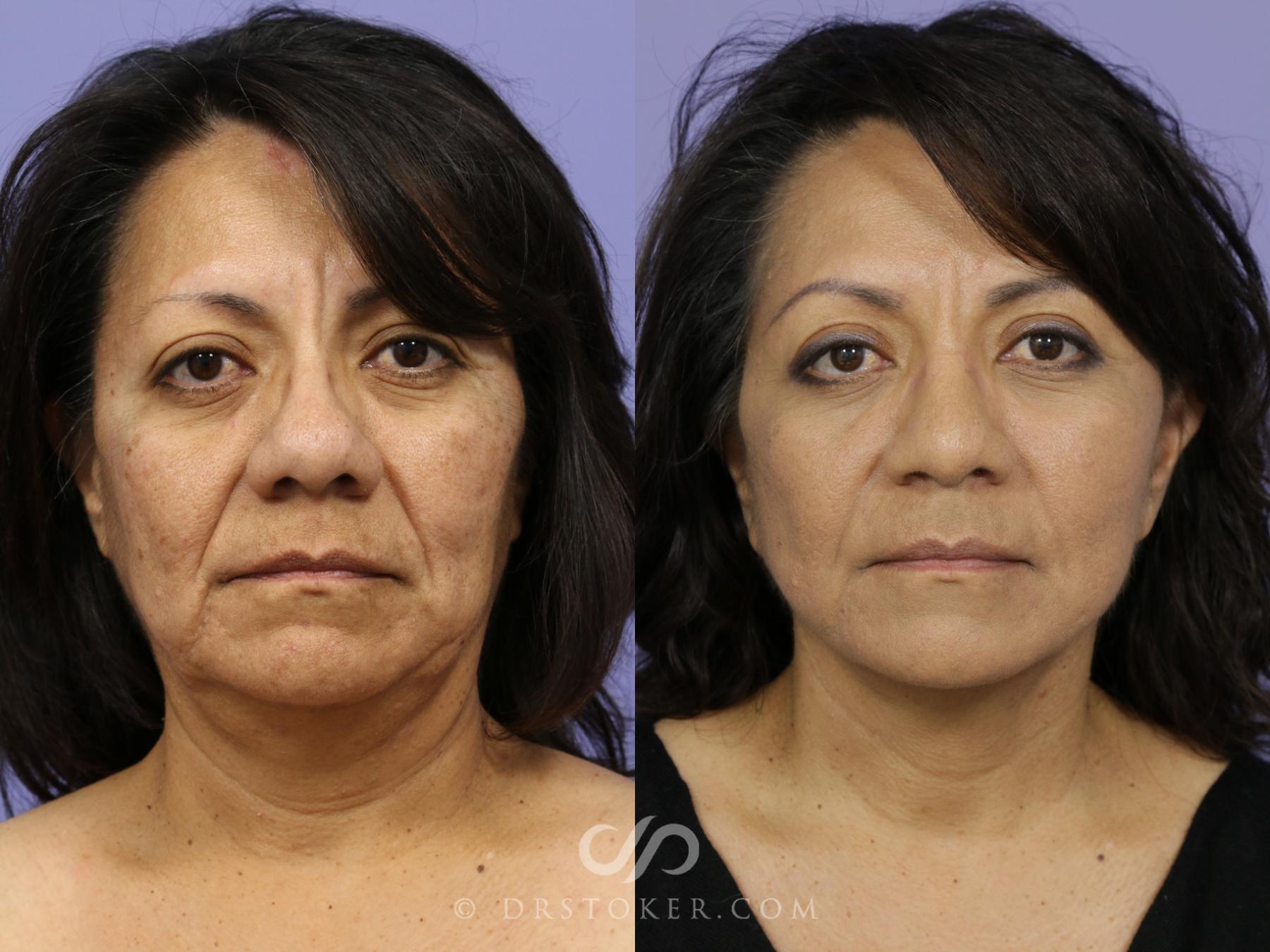 Before & After Facelift - Traceless Facelift Case 812 View #1 View in Los Angeles, CA